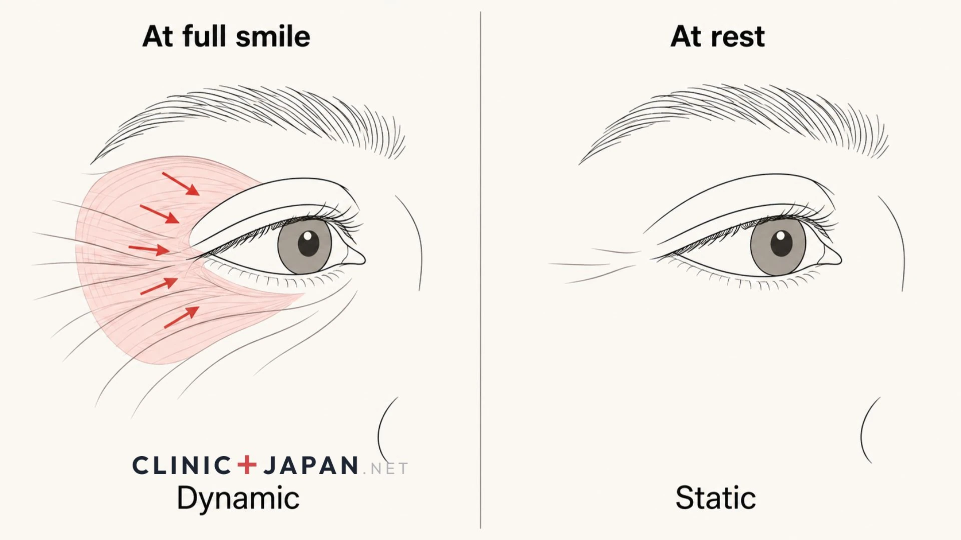 Illustration contrasting lateral canthal lines visible only at full smile with lines that remain visible at rest