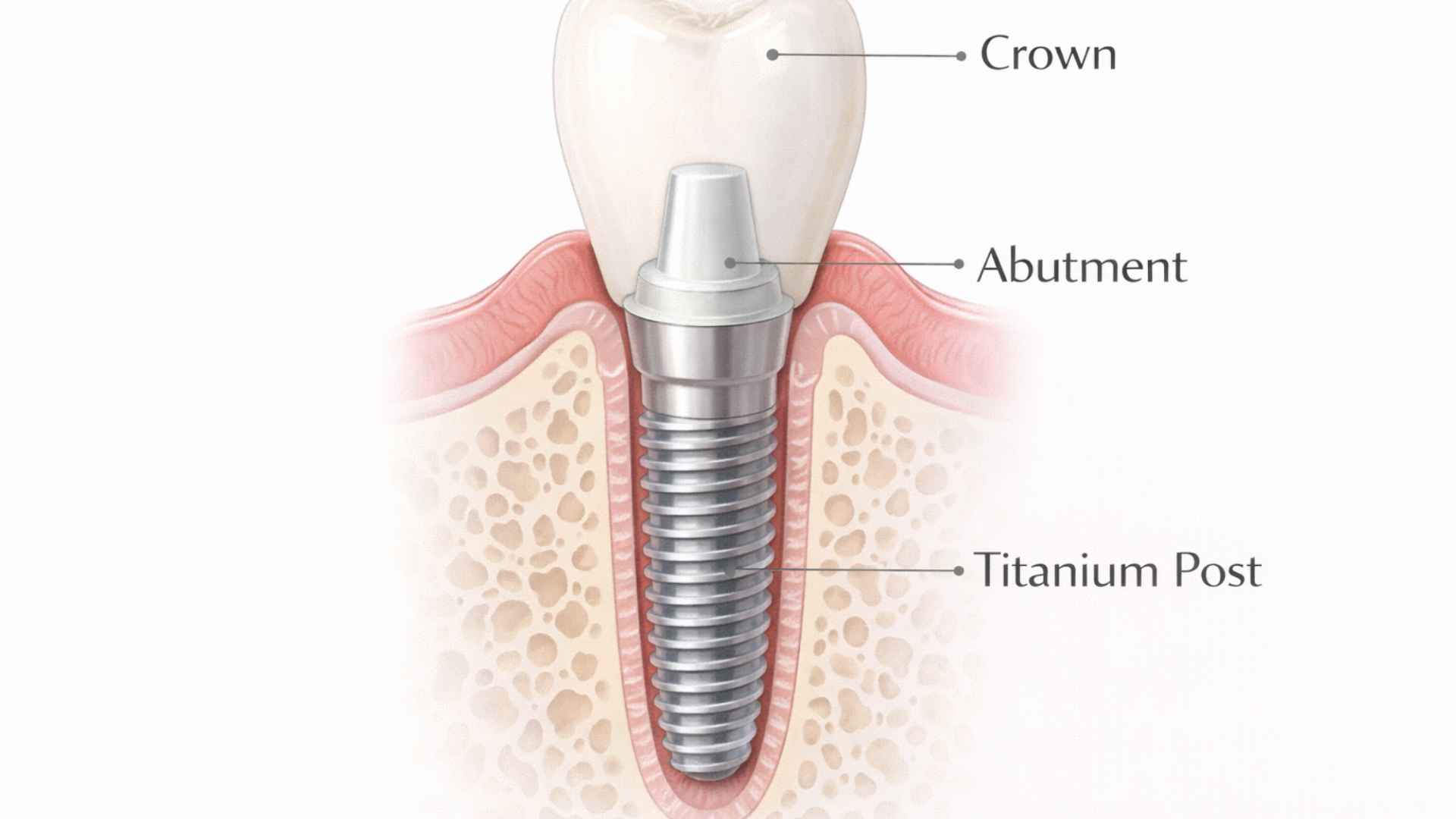 Cross-section diagram of dental implant showing titanium post crown and abutment components