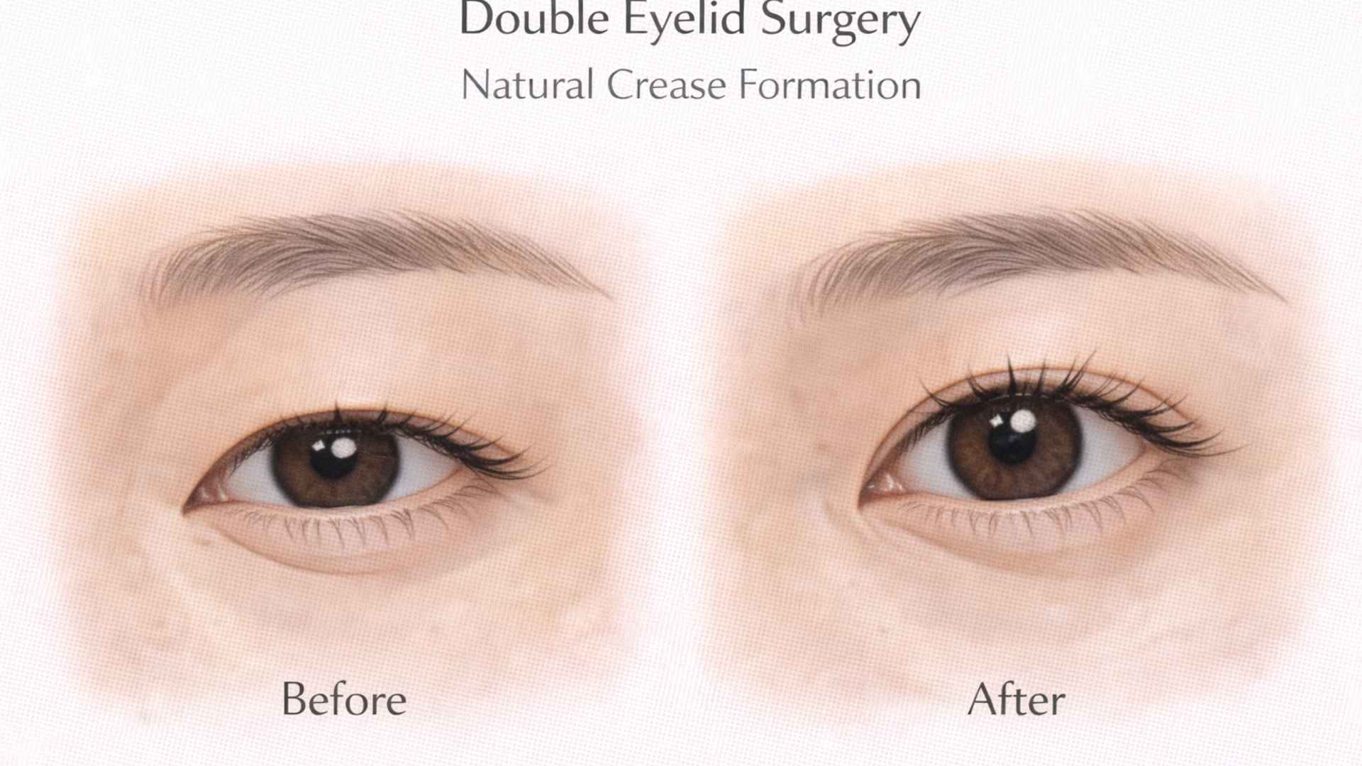 Illustrated before and after double eyelid surgery showing natural crease formation