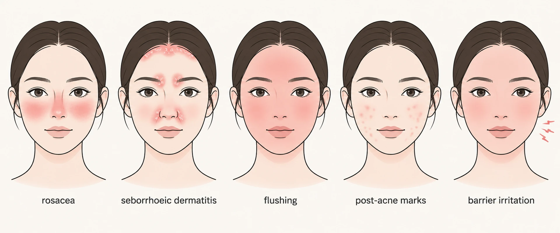 Diagram of a face showing five distribution patterns of redness: central cheeks and nose for rosacea, nose folds and eyebrows for seborrhoeic dermatitis, whole-face flush, scattered acne-site marks, and diffuse barrier irritation
