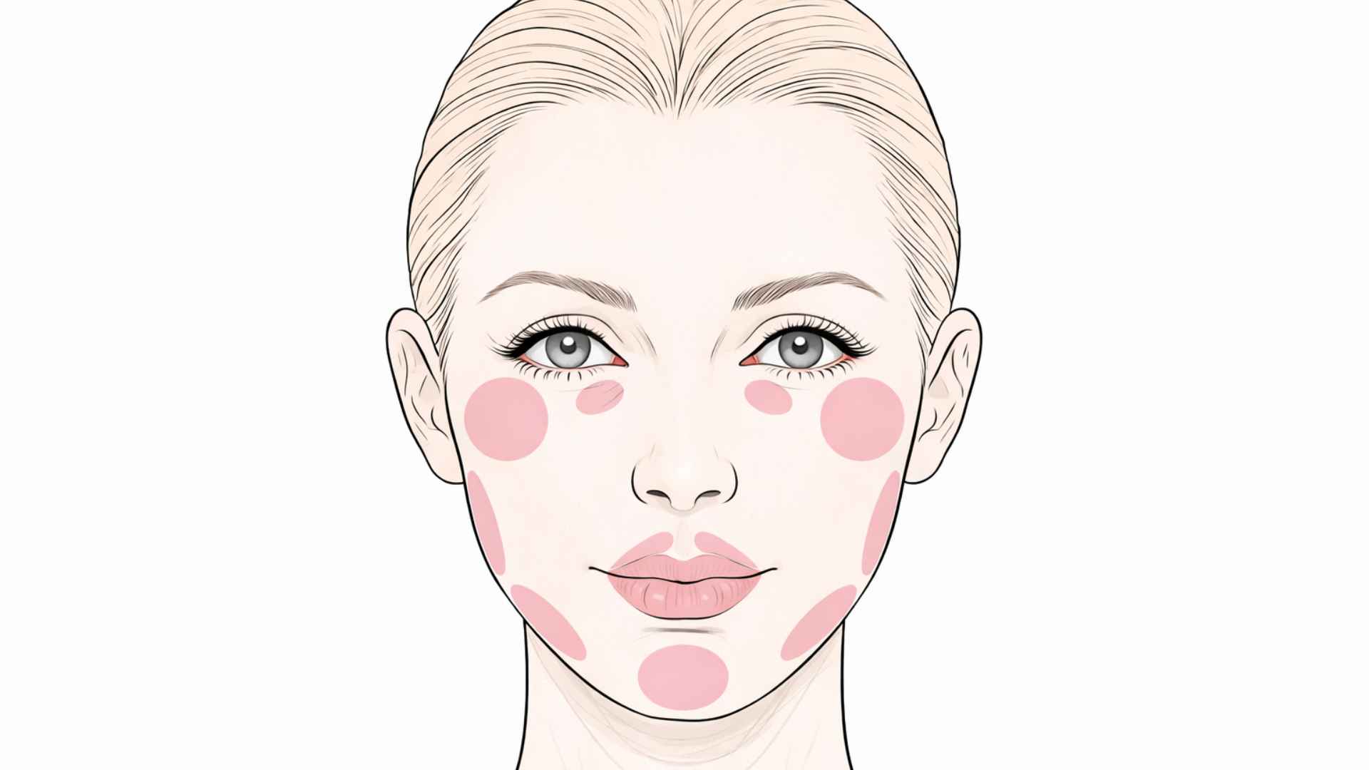 Face diagram showing common dermal filler injection areas — cheeks, lips, nasolabial folds, chin, under-eye, jawline