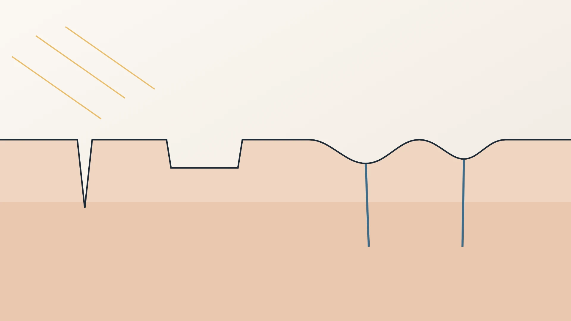 Illustration of skin in cross-section under angled light, showing a narrow icepick scar, a flat-bottomed boxcar scar and wavy rolling scars tethered by bands underneath