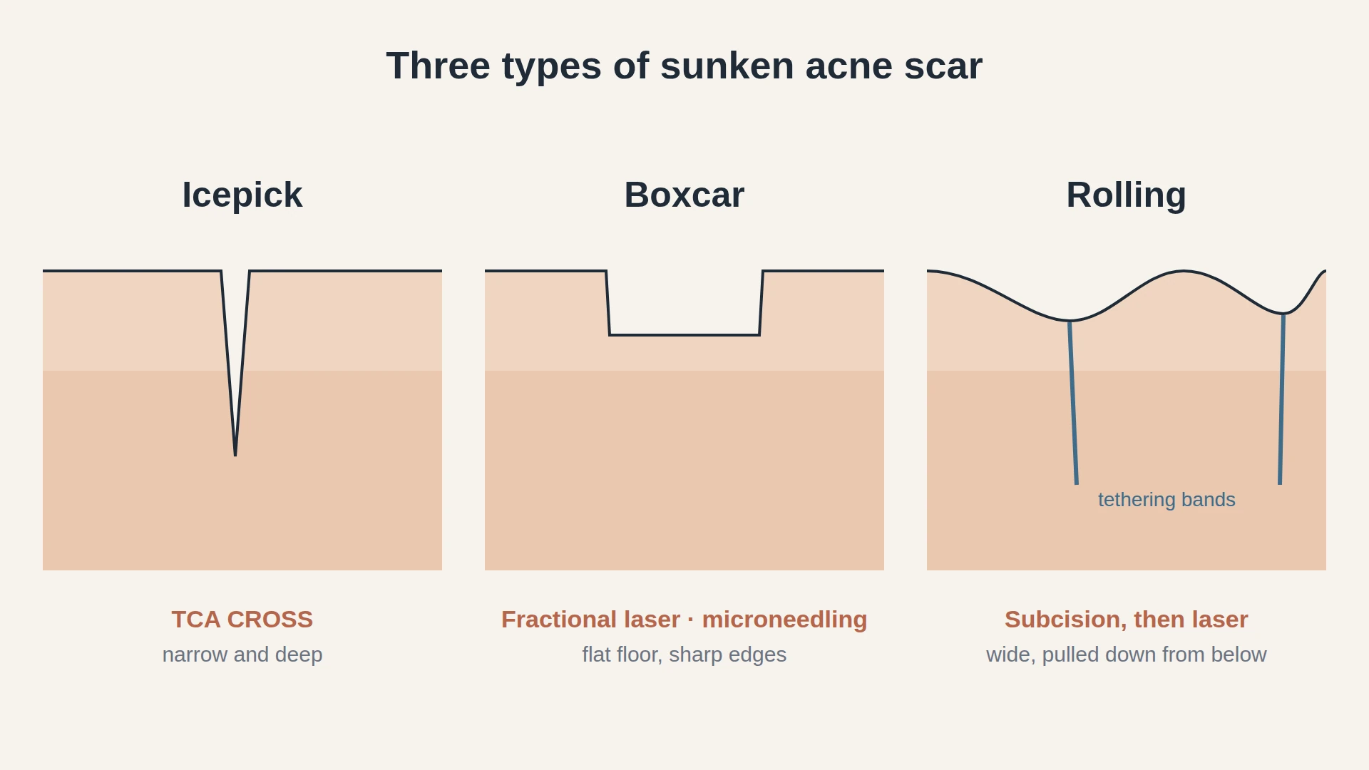 Cross-section diagram of three acne scar types in the skin: a narrow deep icepick scar, a flat-bottomed boxcar scar with sharp edges, and a wide rolling scar pulled down by fibrous bands underneath, each labelled with its usual treatment