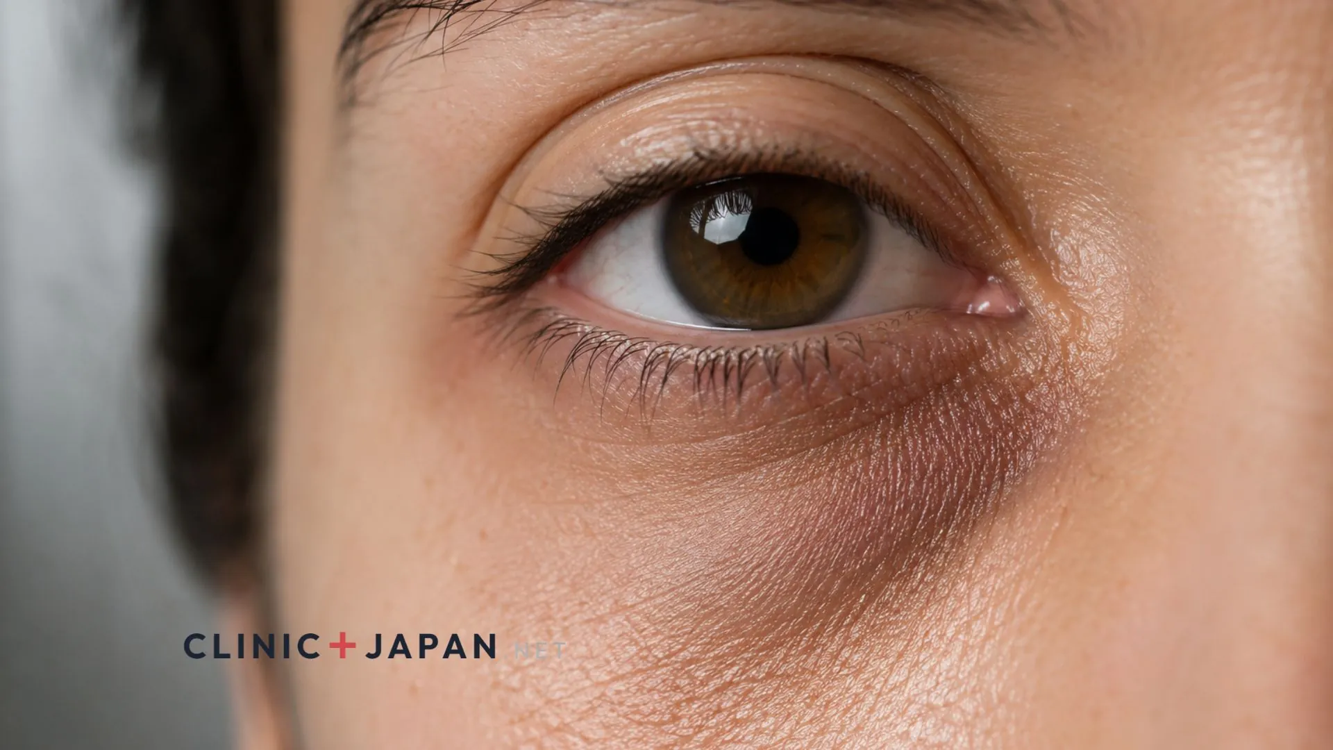 Close-up of a lower eyelid area lit from two angles, showing how under-eye darkness changes with the direction of light