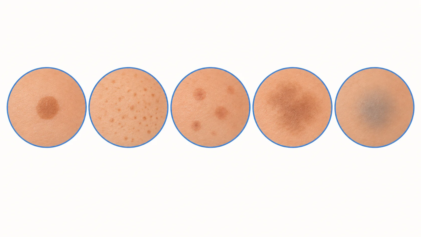 Five illustrated skin close-ups comparing a round sun spot with clear edges, scattered freckles, a brown mark left after acne, blurred melasma patches, and grey-blue deeper pigment on the cheekbone