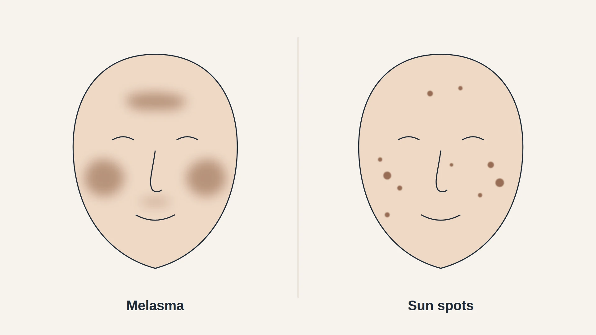 Illustration comparing blurred symmetrical melasma patches on both cheeks with separate round sun spots, on an off-white background