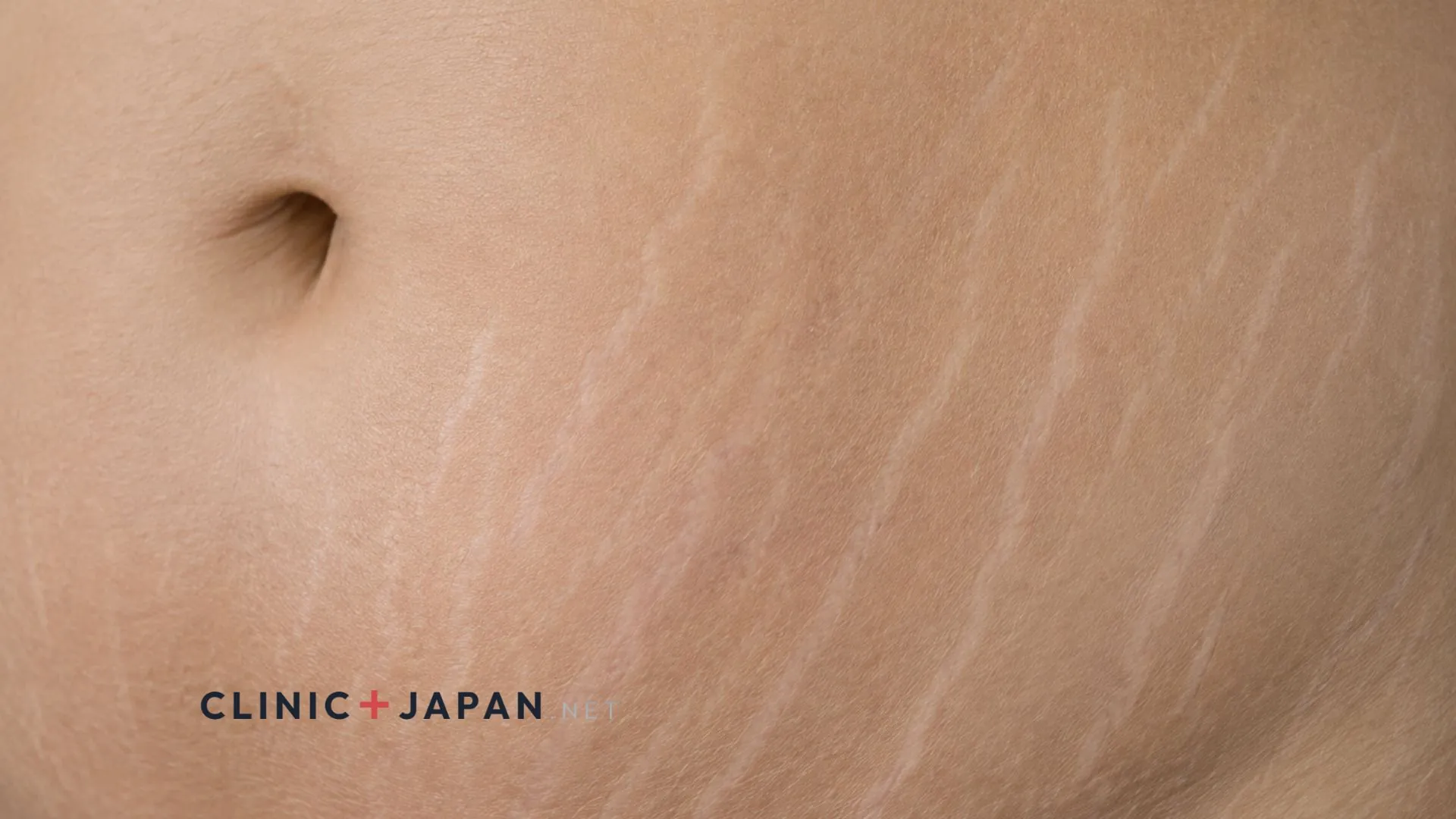 Close-up of skin on the abdomen showing pale linear striae running across the surface