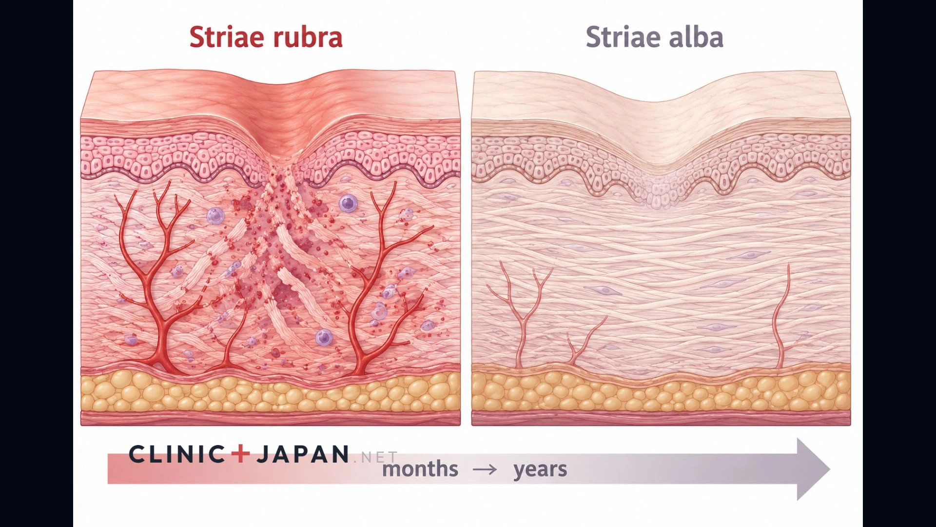 Illustration comparing red inflamed early stretch marks with pale mature stretch marks in cross-section through the dermis