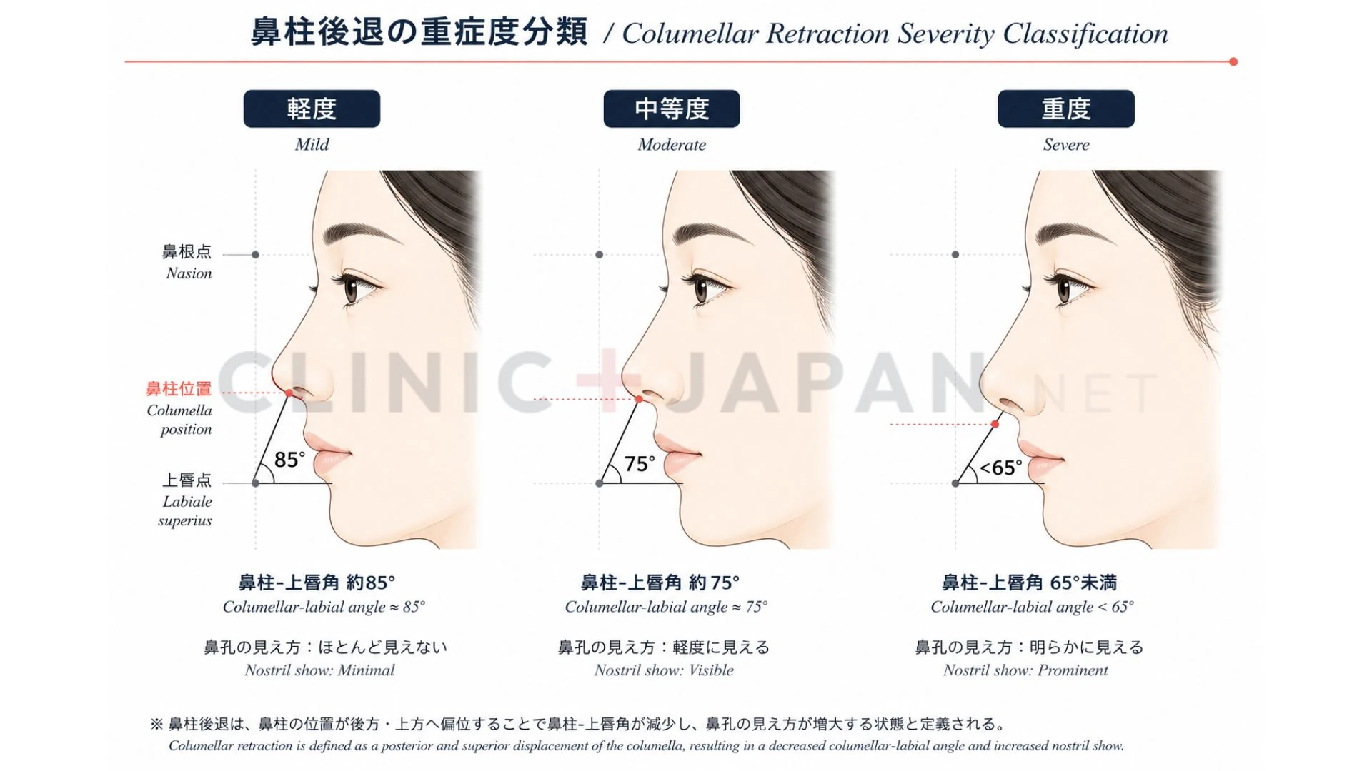 鼻柱下降術の解剖 — 鼻中隔軟骨・内側脚・鼻柱皮膚の構造
