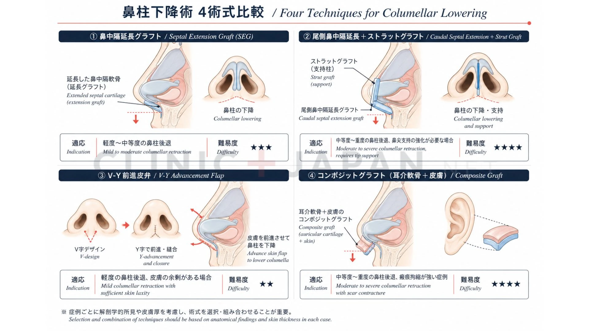 鼻柱下降術の4術式 — SEG・V-Y advancement・composite graft・肋軟骨