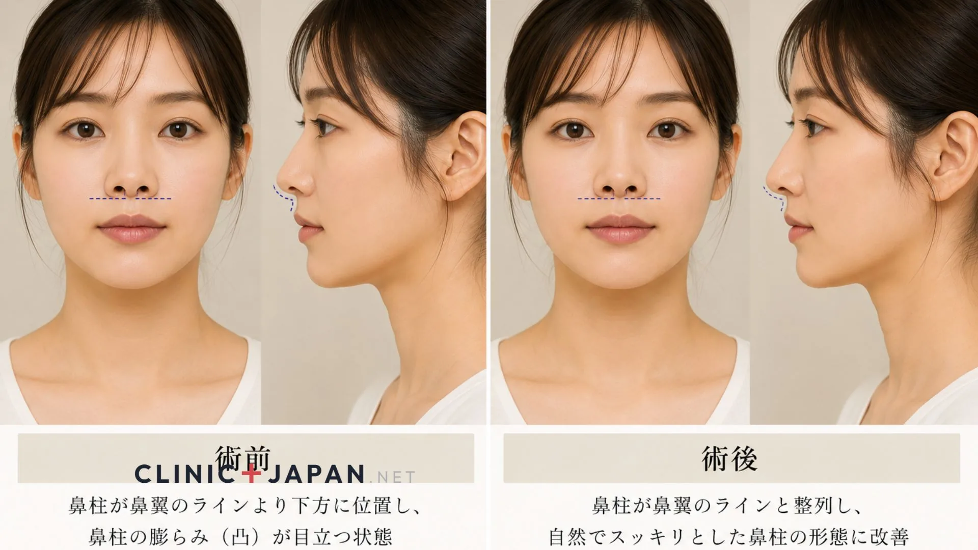 鼻柱縮小 — hanging columella を短縮し正面からの鼻孔露出を整える