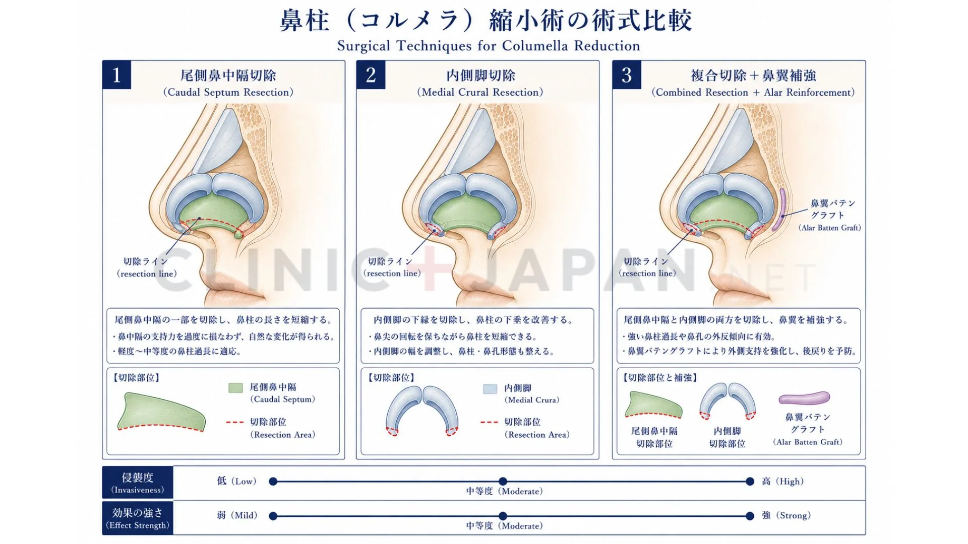 鼻柱縮小の3術式 — 尾側鼻中隔切除・内側脚切除・複合切除＋鼻翼補強