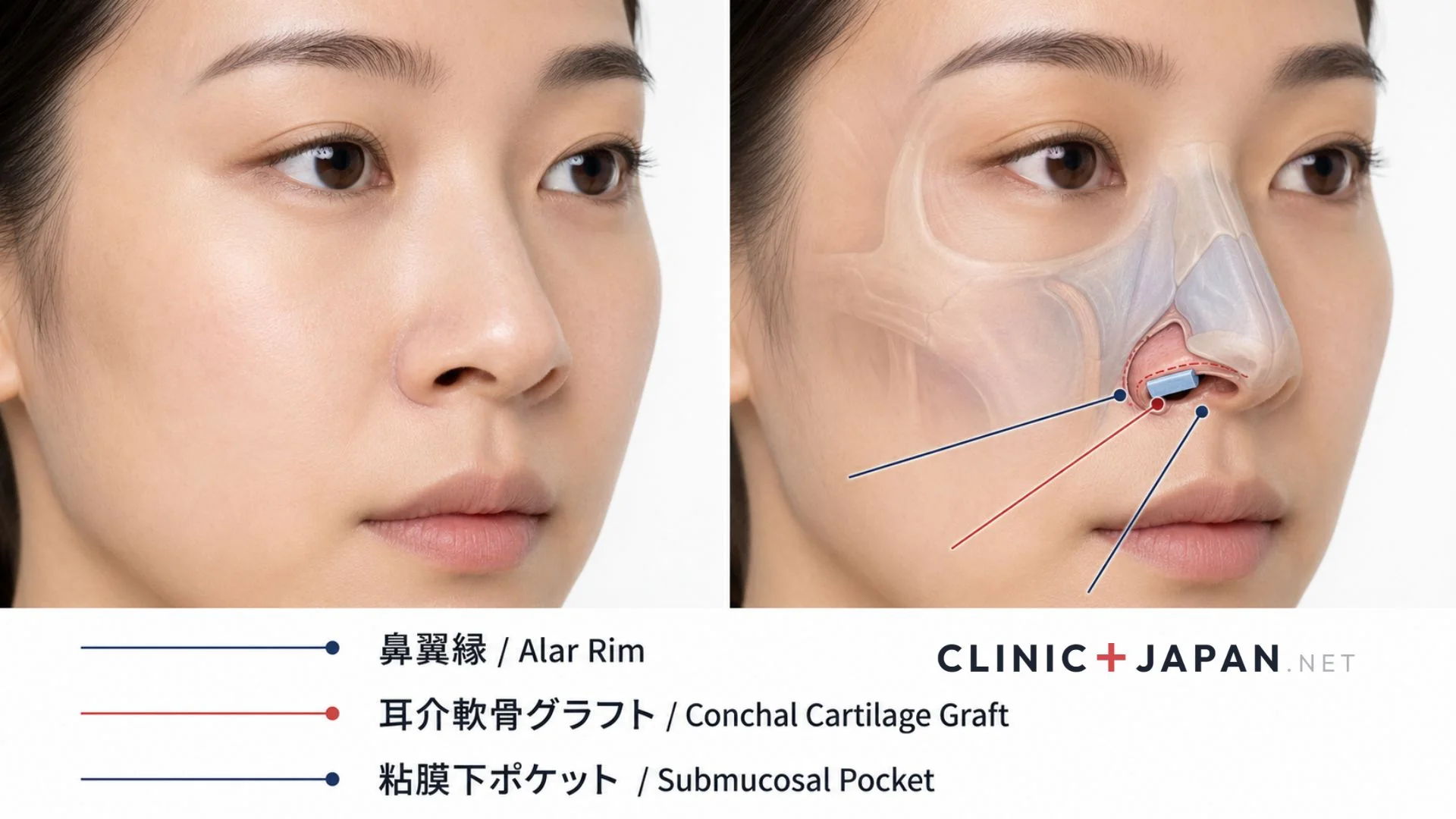 鼻孔縁下降術 alar rim graft — 軟骨移植による鼻翼縁の形成手術