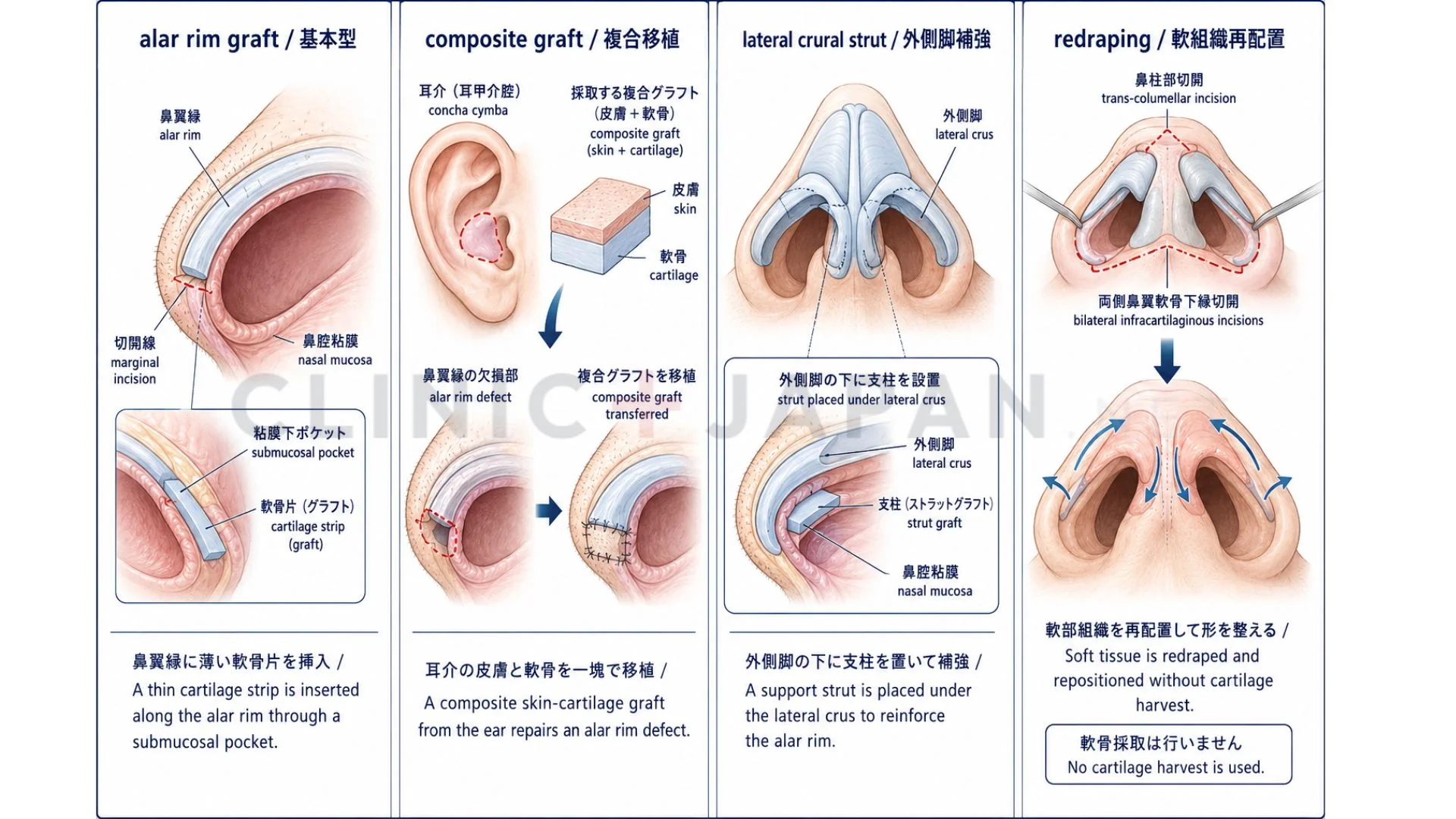 鼻孔縁下降術 主な術式4タイプの比較 — alar rim graft・composite graft・lateral crural strut graft・redrapingの図解