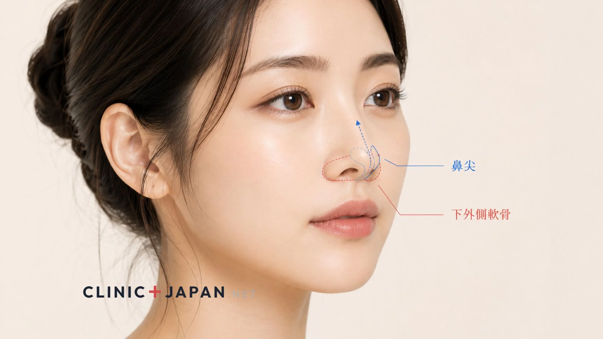 鼻尖形成 — 丸い鼻先・団子鼻を細く整える鼻先形成術の全体像