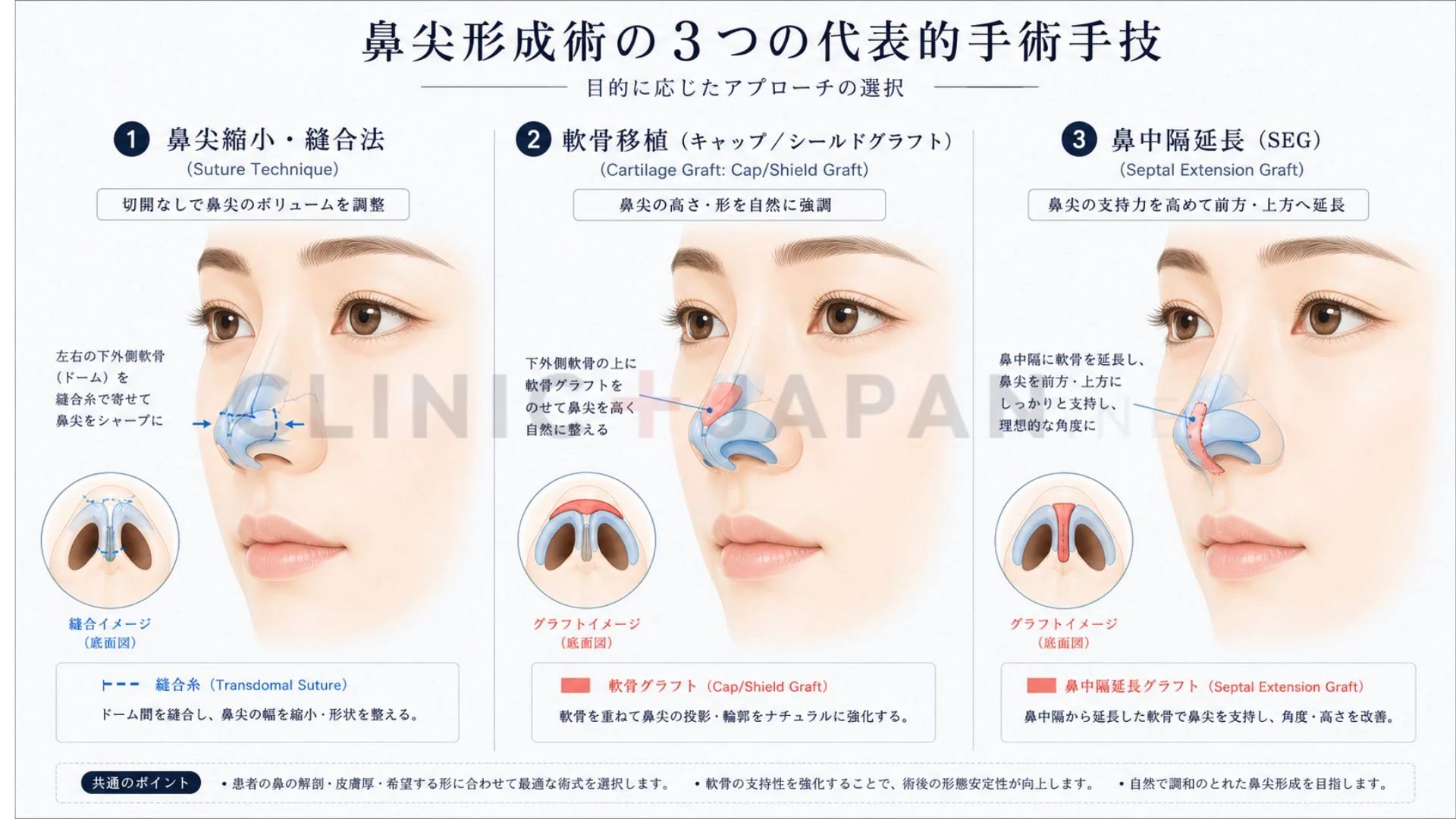 鼻尖形成の3術式 — 縫合法・軟骨移植・SEGの違いと適応