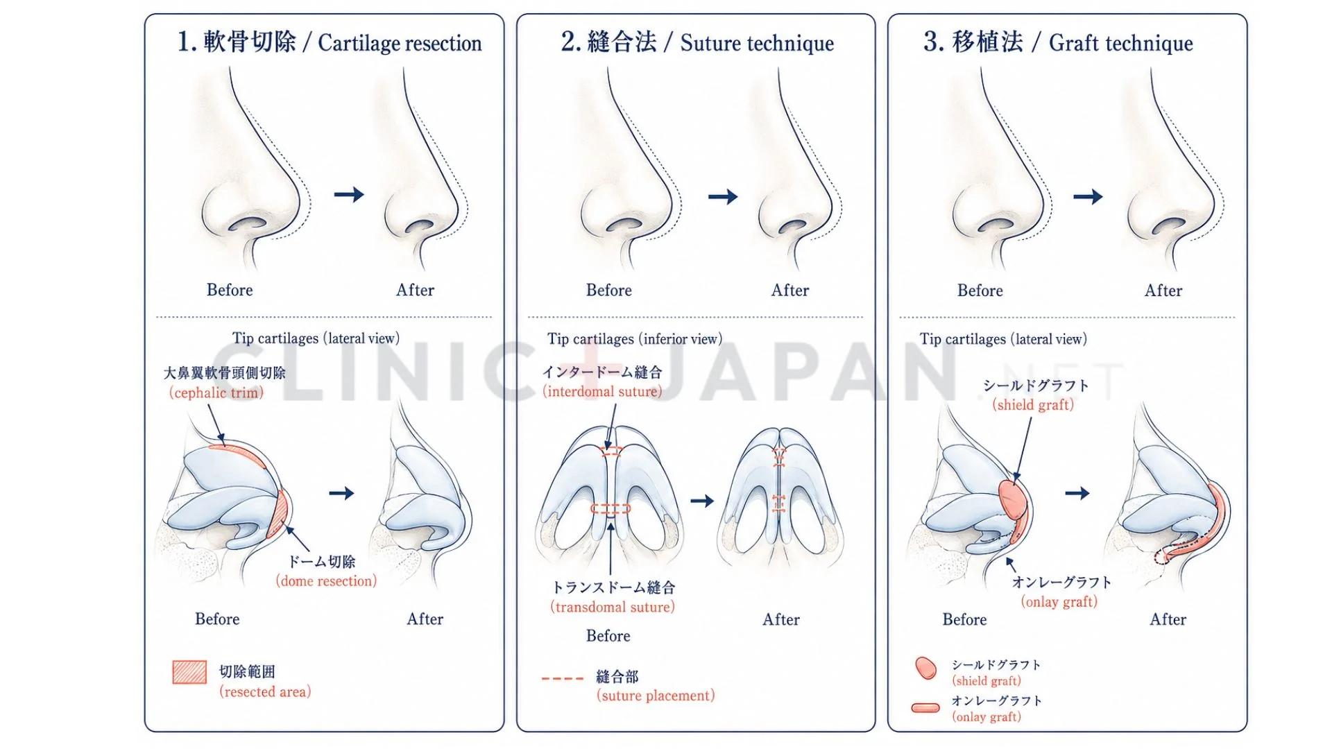 鼻尖縮小の3系統術式 — 軟骨切除・縫合法・移植法の比較と適応