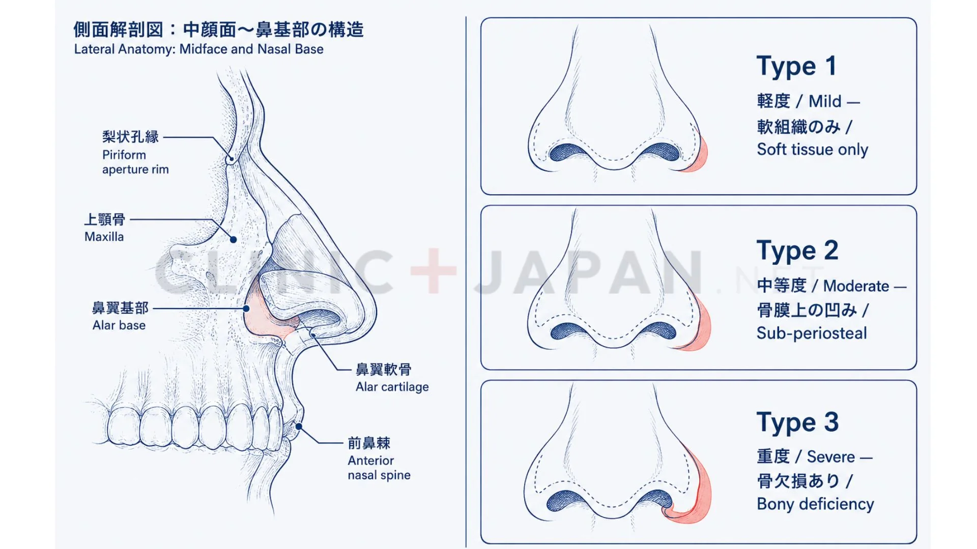鼻翼基部陥没の解剖図 — 梨状孔縁・上顎骨・鼻翼基部の位置関係と凹みの輪郭