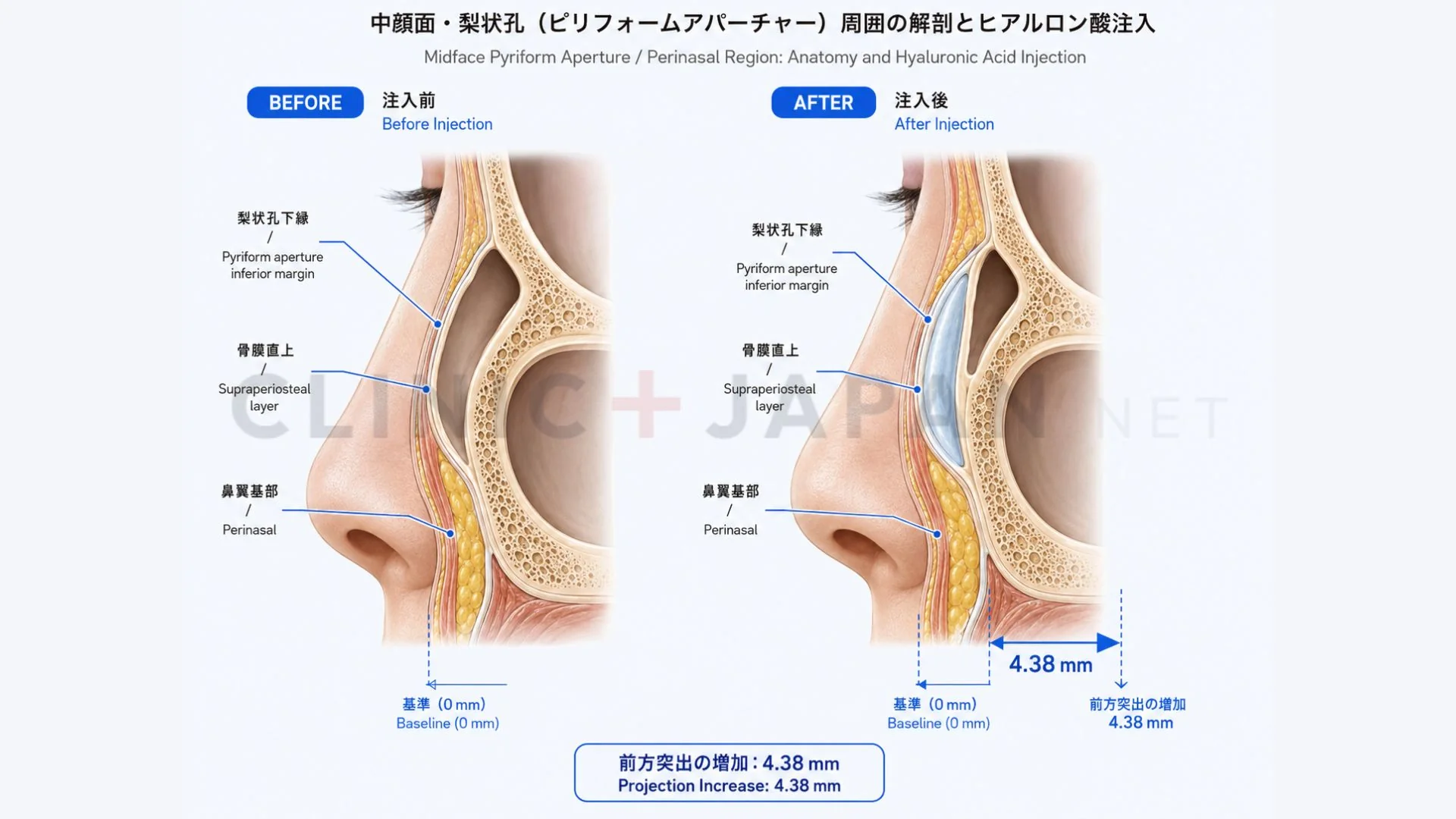 鼻翼基部の解剖図 — 梨状孔下縁・顔面動脈分枝・脂肪パッドと注入ターゲット領域