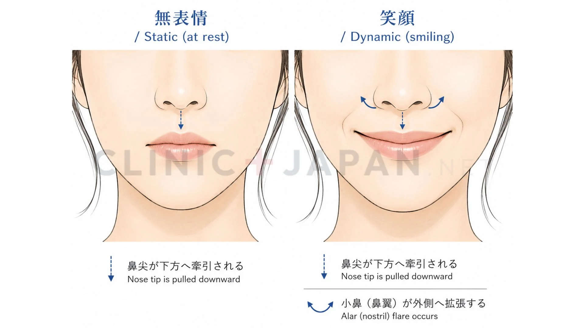 鼻ボトックス注入ポイント — DSN・鼻筋横走部・鼻翼部・上唇鼻翼挙筋の位置と用量