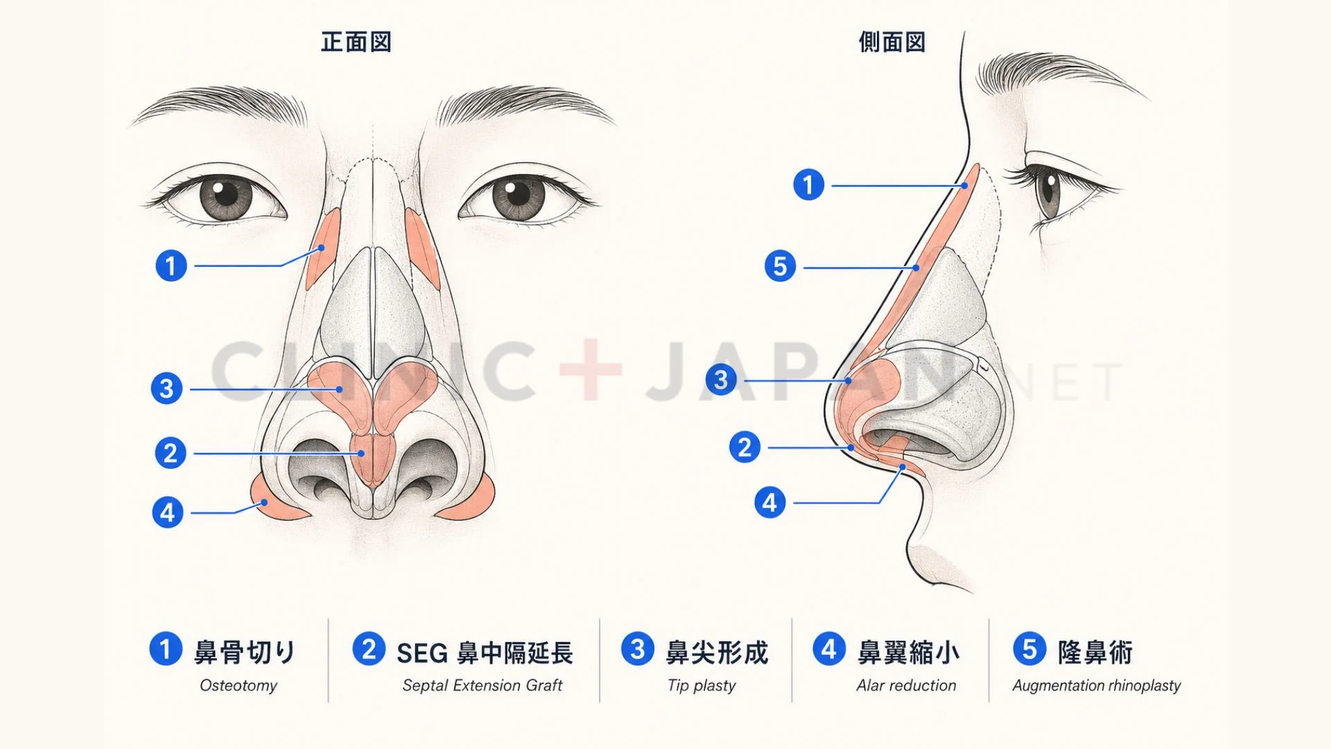 鼻フルの5術式 — 隆鼻・SEG・鼻尖形成・鼻翼縮小・鼻骨切りの解剖学的範囲