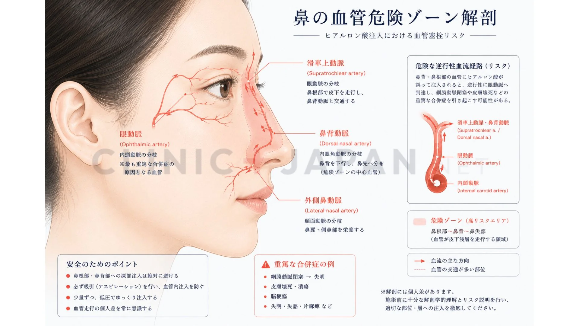 鼻の血管解剖図 — 鼻背動脈・滑車上動脈・眼動脈と注入危険ゾーン