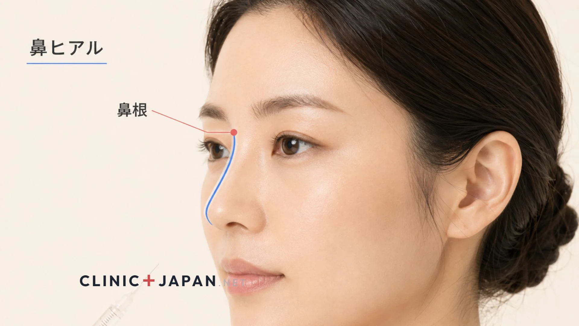 鼻ヒアルロン酸 — 非外科的隆鼻術の効果と血管閉塞リスクの全体像