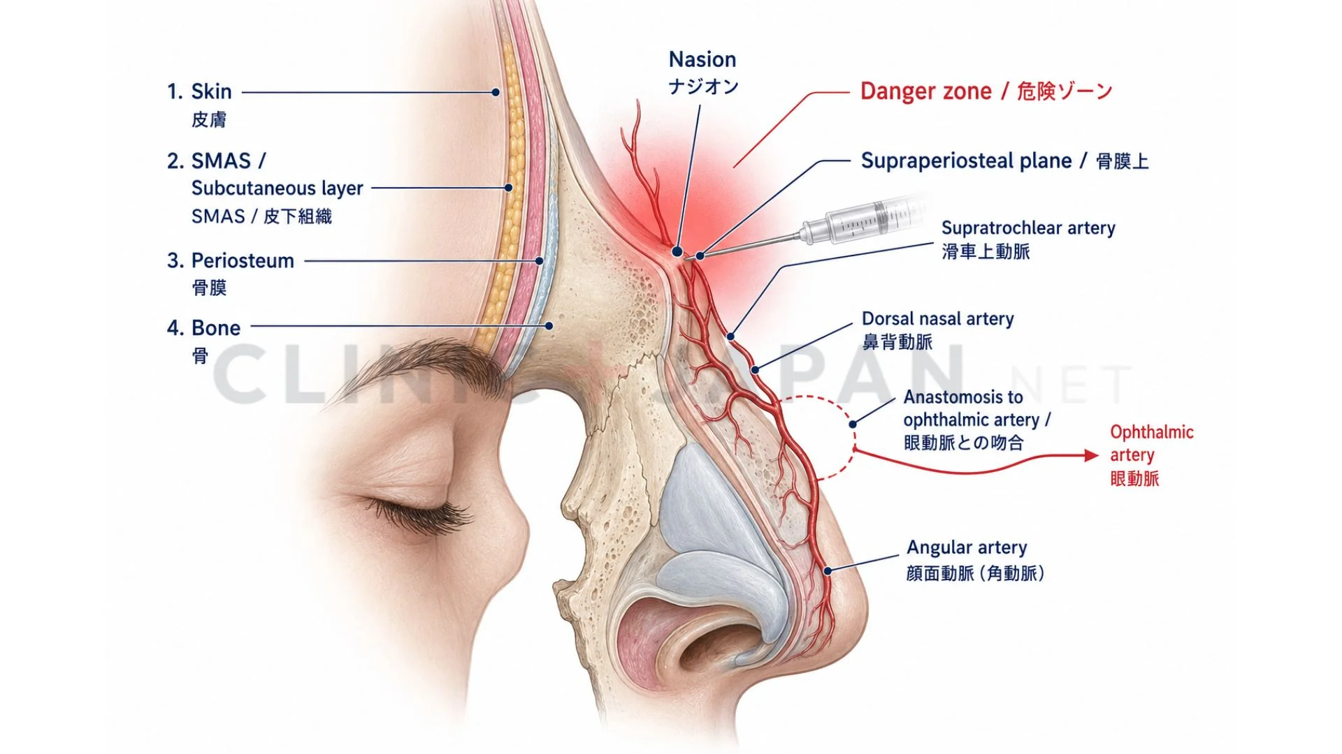 鼻根ヒアルロン酸の解剖図 — ナジオン位置・骨膜上注入層・眼動脈との吻合の整理