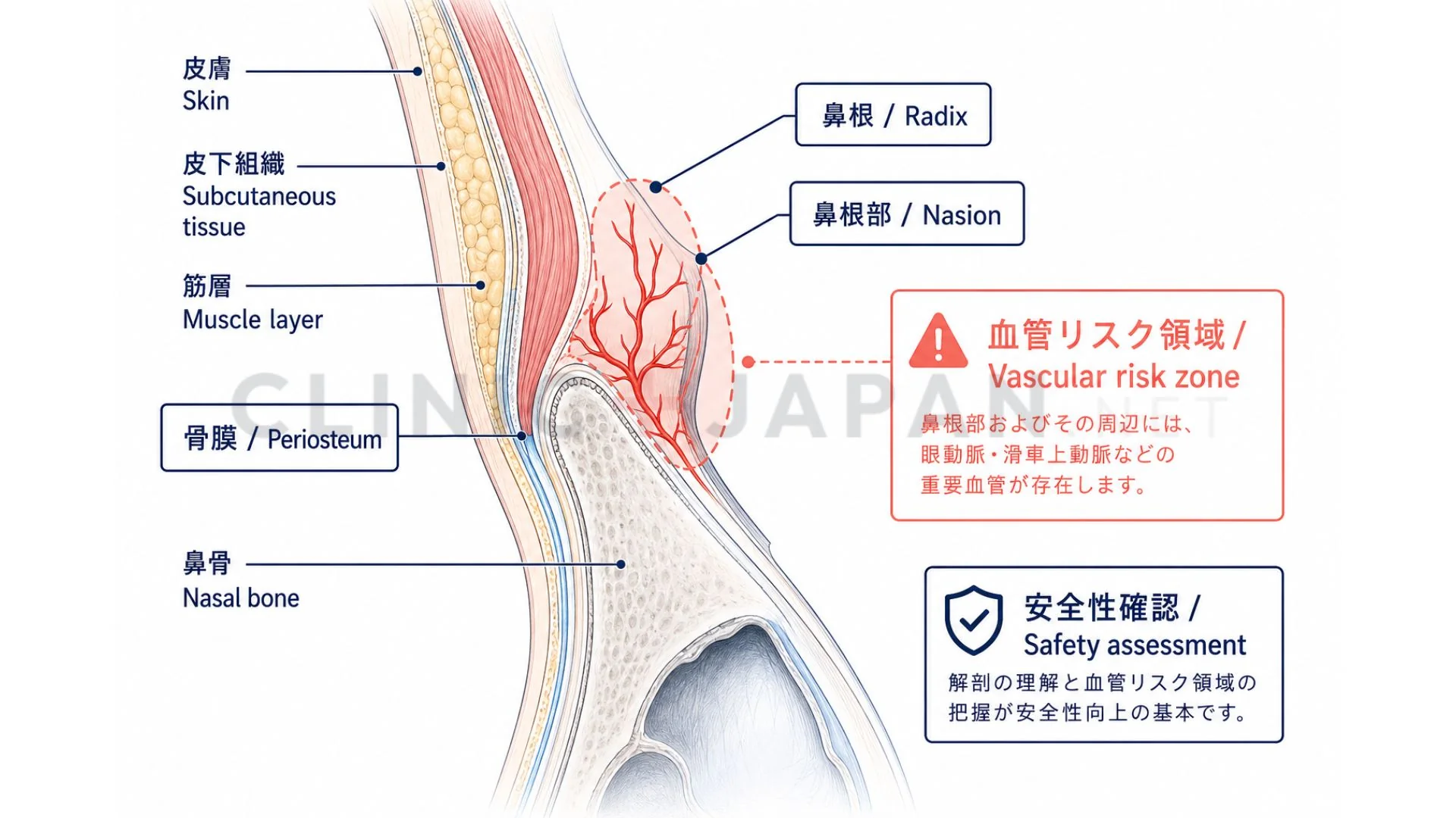 鼻根ヒアルロン酸の注入手技 — 骨膜上注入層・吸引テスト・少量ボーラスの整理