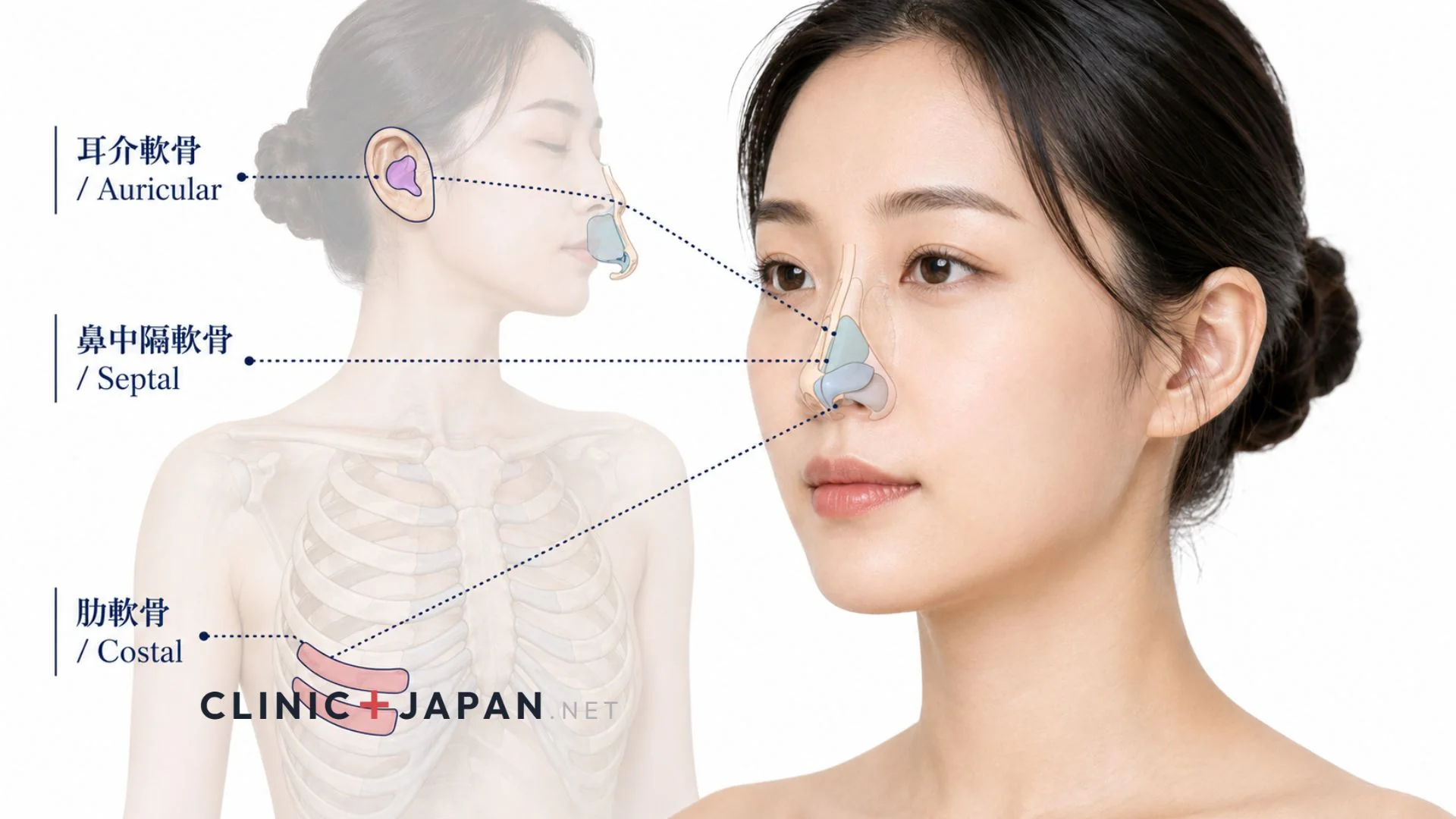 鼻軟骨移植 3つの採取部位 — 肋軟骨・耳介軟骨・鼻中隔軟骨の比較
