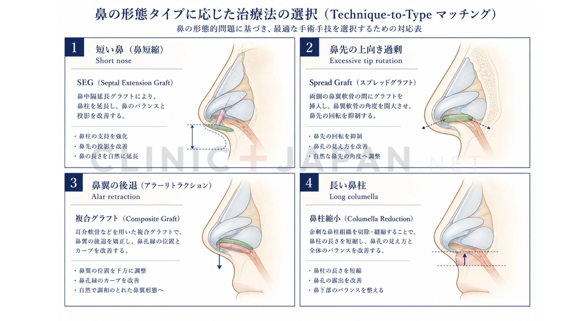 鼻の穴が見える4タイプの治療法マトリクス — SEG・spread graft・複合グラフト・鼻柱縮小の使い分け