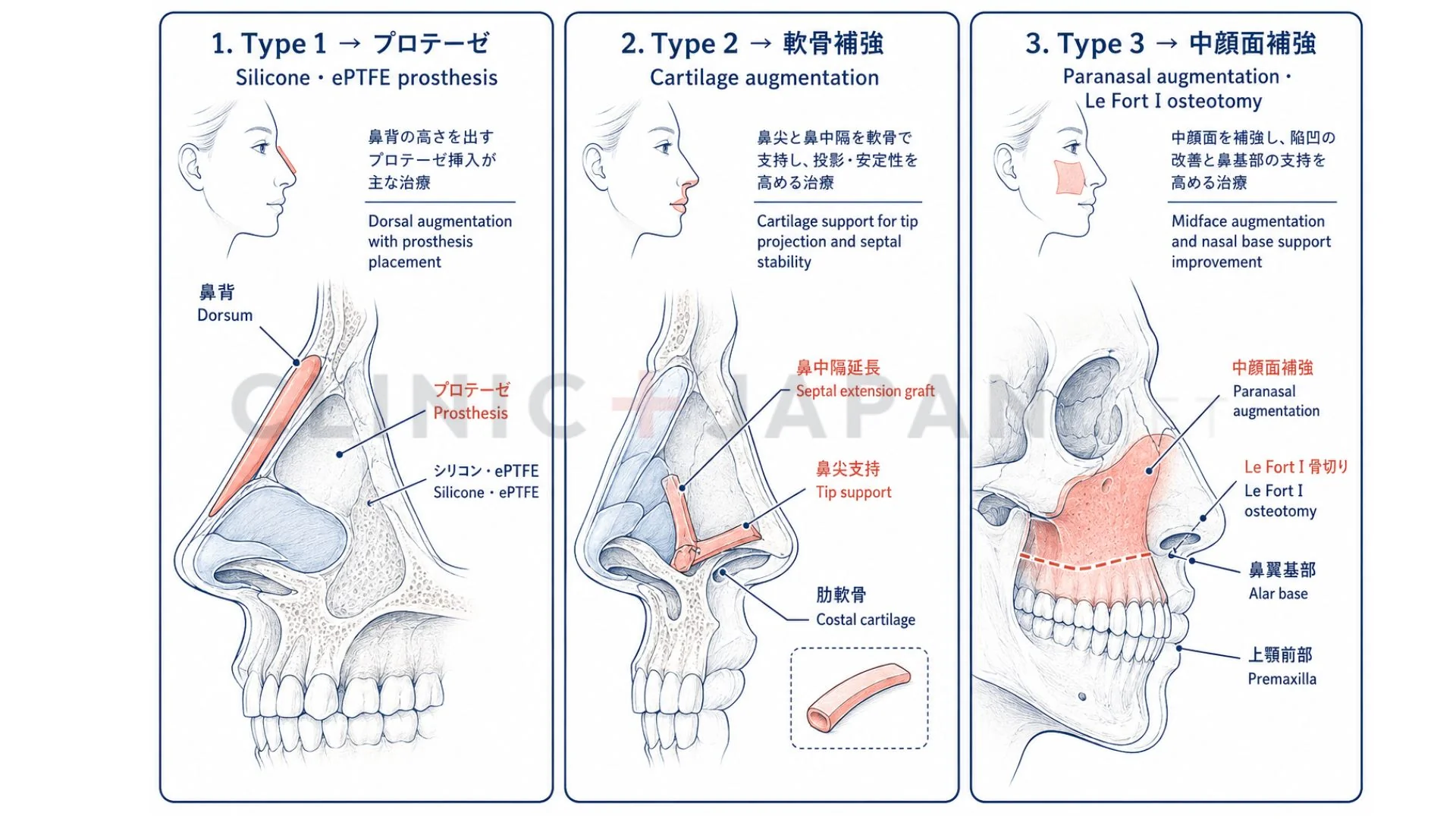 鼻の骨がない感覚の改善方法 — タイプ1（プロテーゼ）・タイプ2（軟骨補強）・タイプ3（中顔面）の整理