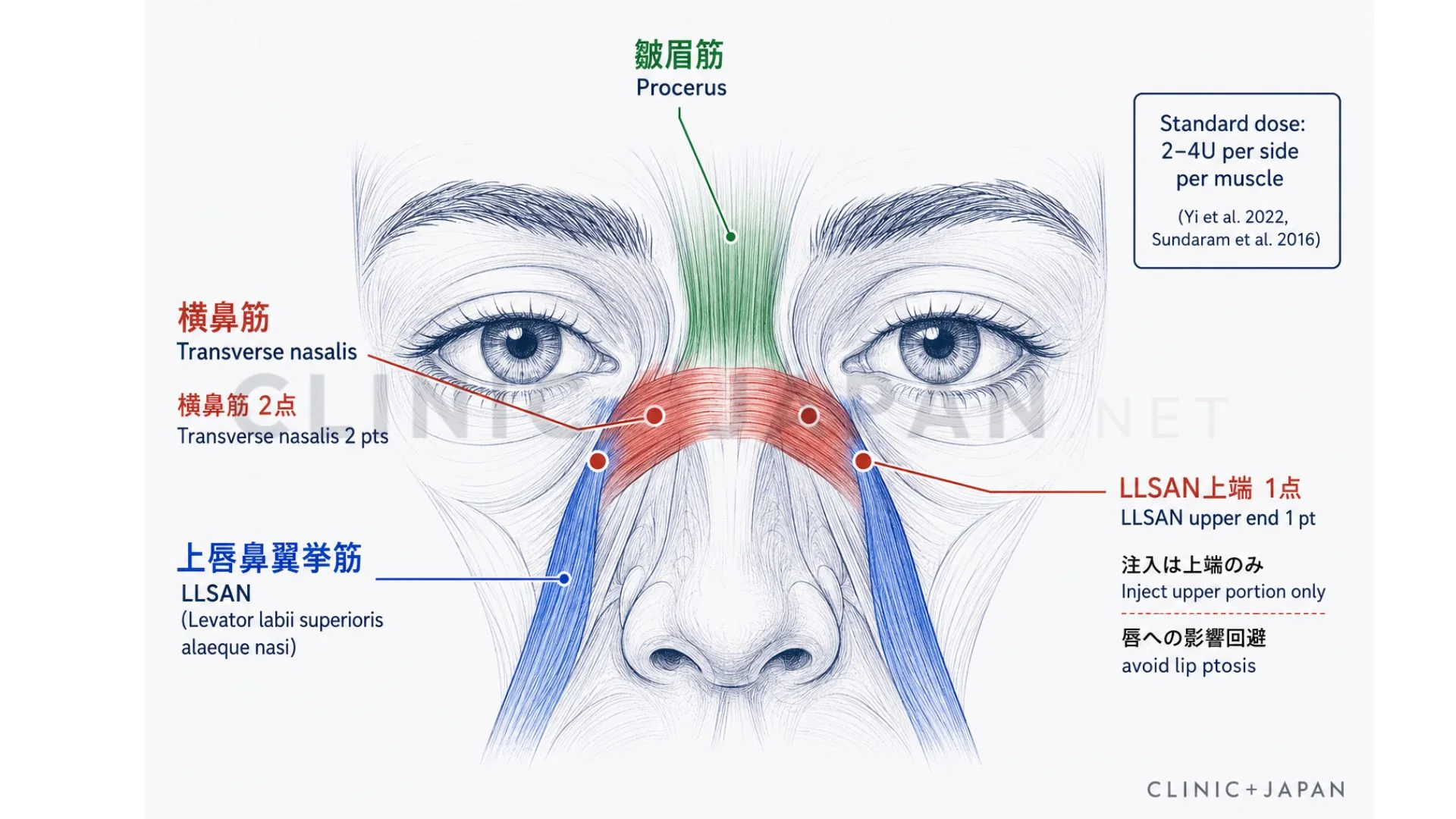 バニーラインの解剖図 — 横鼻筋（transverse nasalis）・LLSAN・procerus筋の関係とボトックス注入点