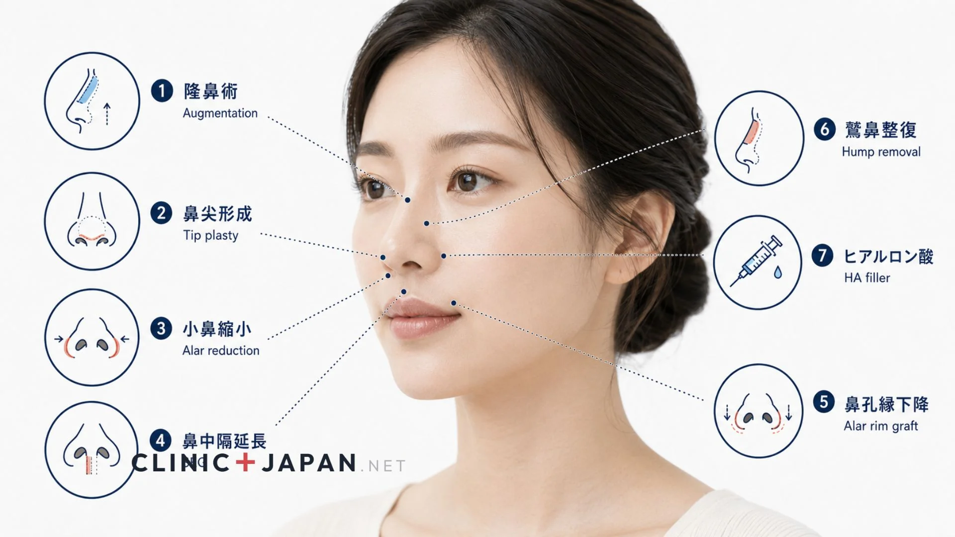 鼻整形の種類 全カテゴリ — 注入・切開・非切開・素材別の分類体系