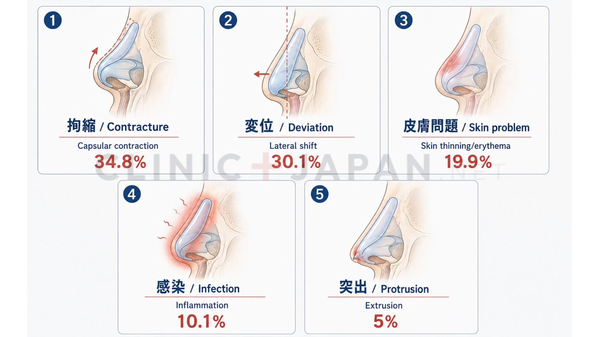 鼻整形の修正・抜去 — シリコンプロテーゼ合併症の主要パターン（拘縮・変位・皮膚問題・感染・突出）の解剖図