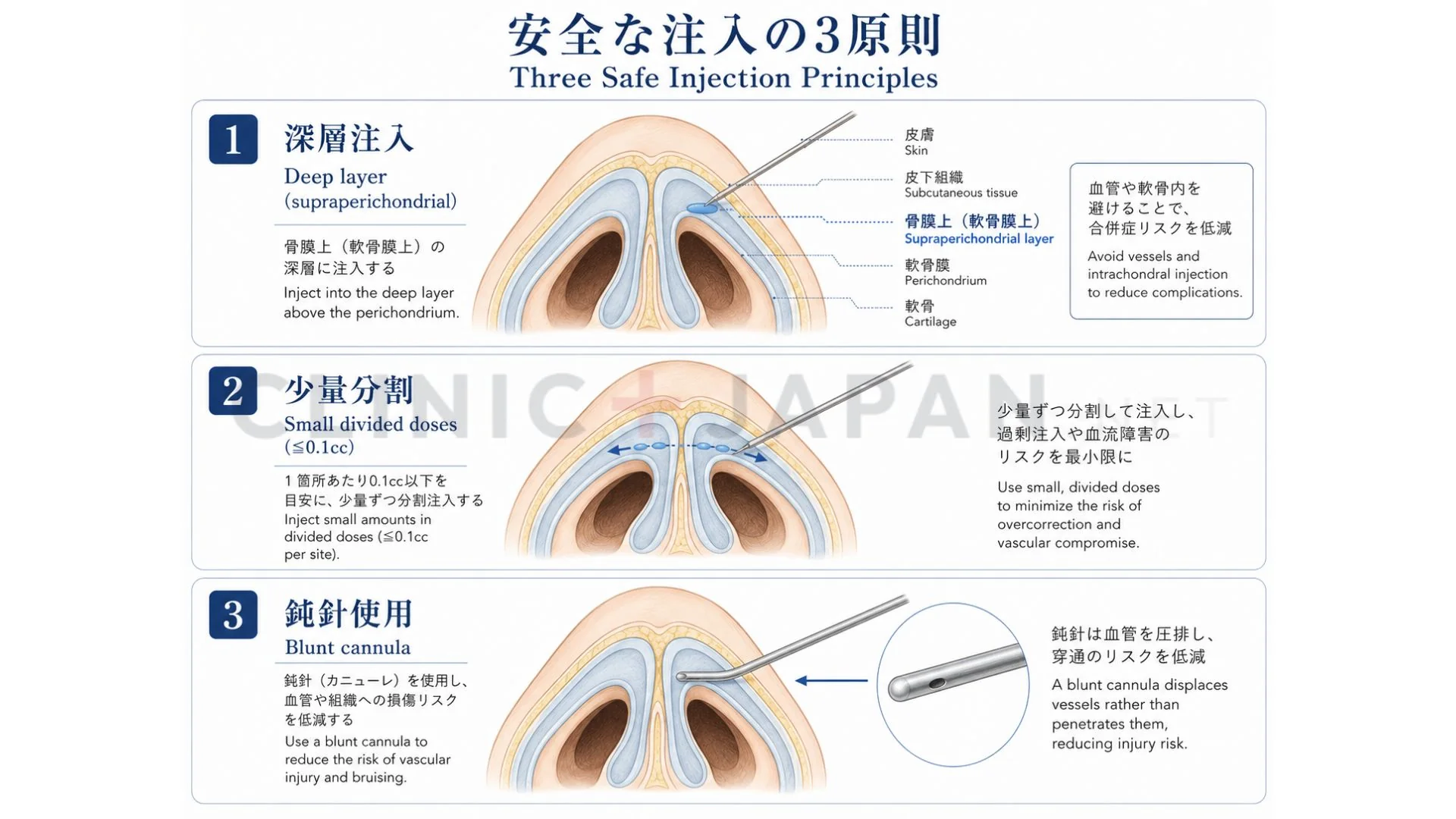 鼻先ヒアル注入テクニック — 軟骨膜直上の深層・少量・分割の3原則