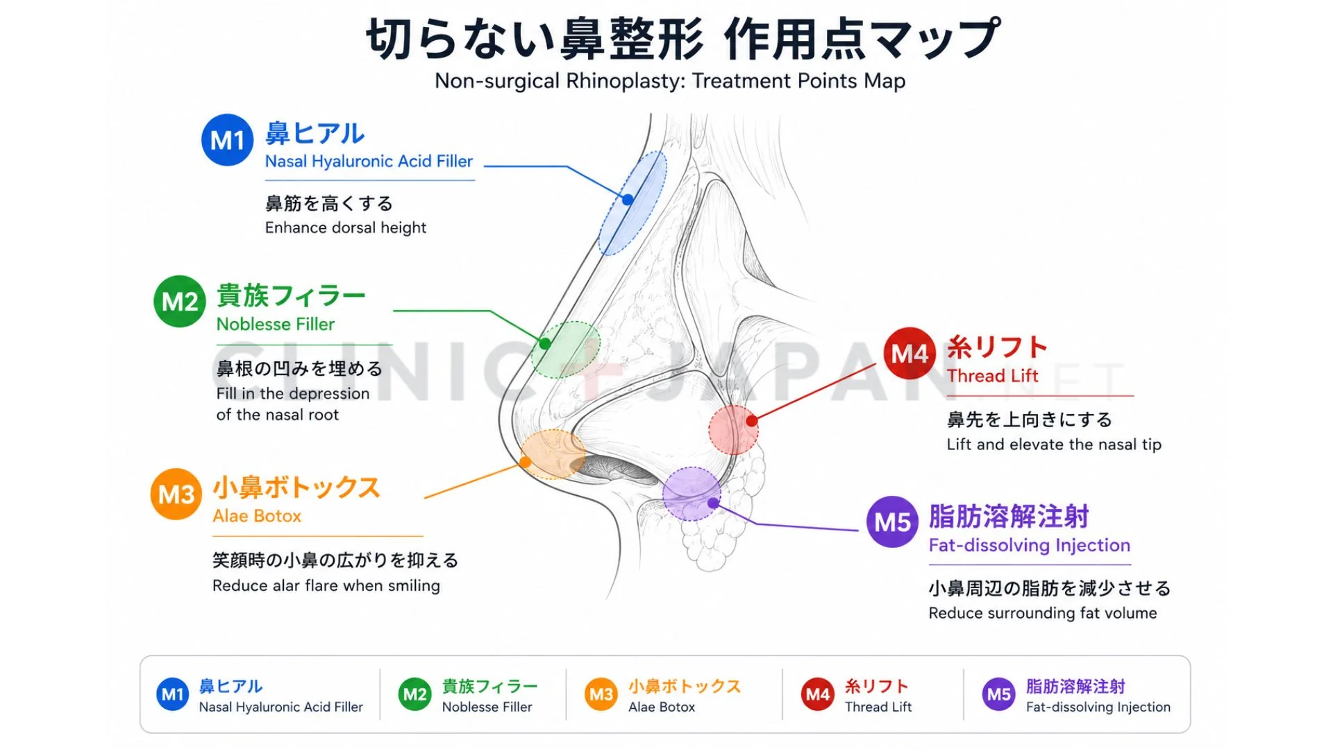 切らない鼻整形 5術式の効くポイント比較図 — 鼻筋・鼻先・小鼻・鼻根の作用点マップ