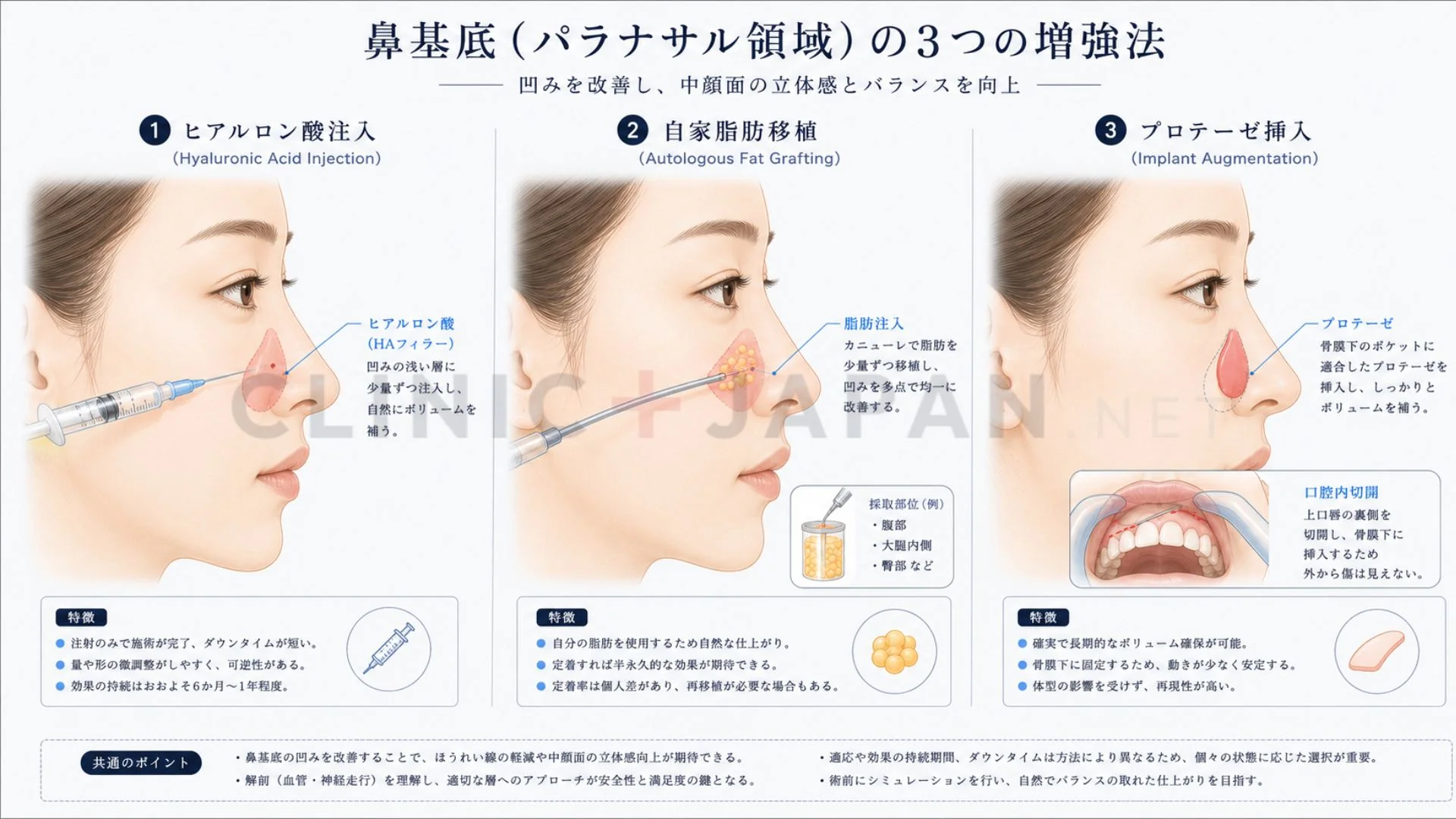 貴族手術の3方法 — ヒアル・脂肪移植・プロテーゼの違いと挿入位置