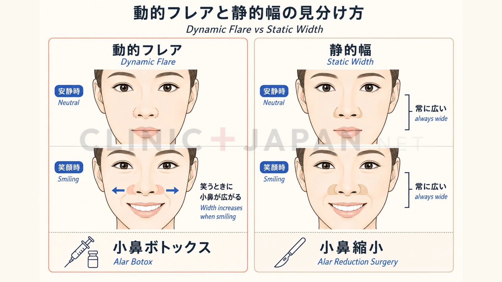 笑顔（動的）と無表情（静的）での小鼻の違い