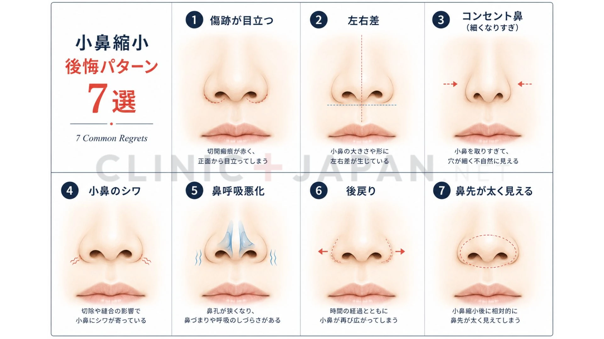 小鼻縮小の後悔7パターン — 原因と回避法