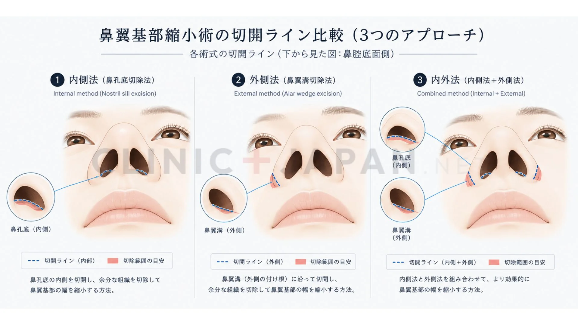 小鼻縮小の3術式 — 内側法・外側法・内外法の切開ラインと効果範囲の比較