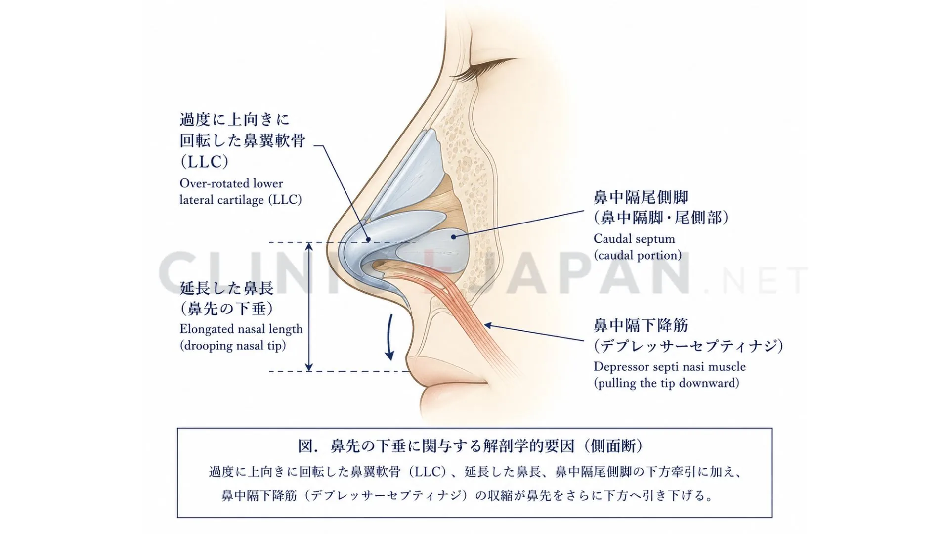 魔女鼻の解剖図 — 過剰回転した鼻翼軟骨と長い鼻長の構造