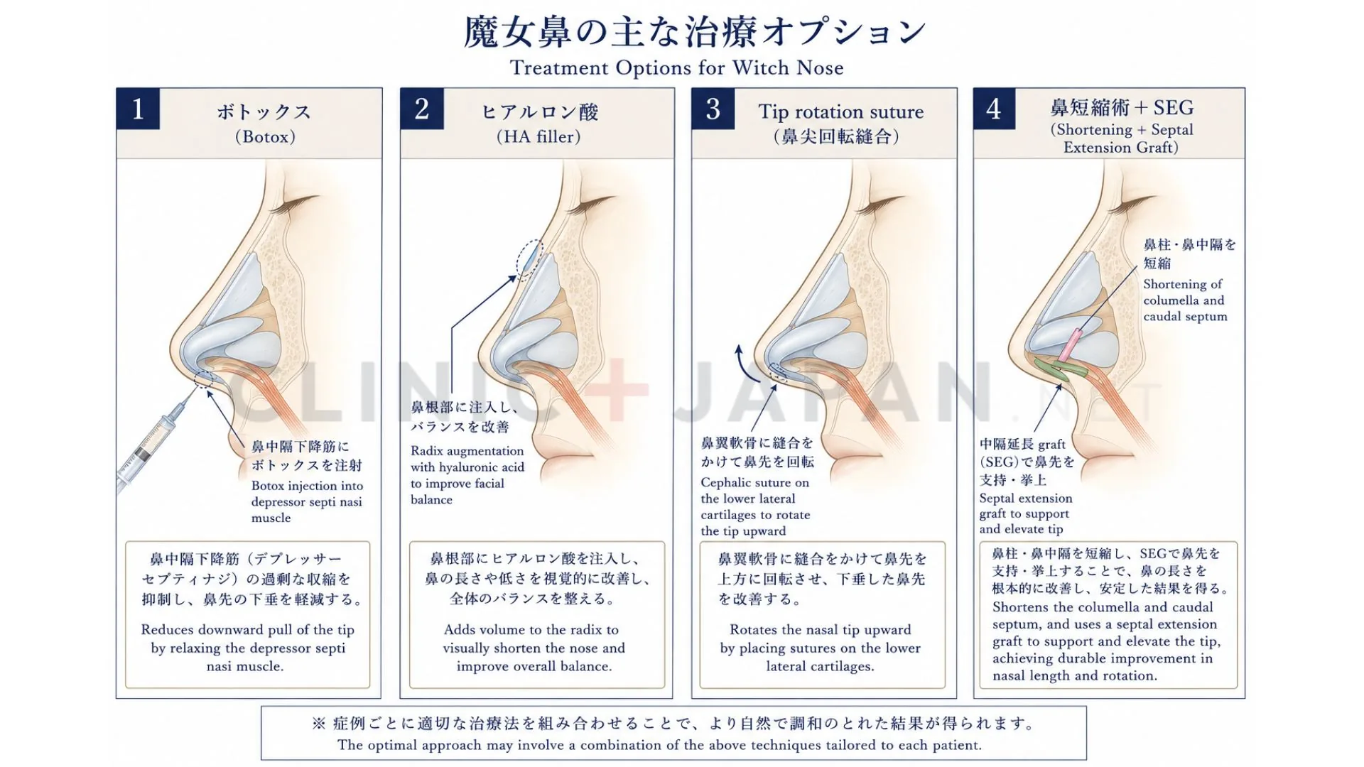 魔女鼻の治療法 — ボトックス・ヒアル・tip rotation・鼻短縮術＋SEGの比較