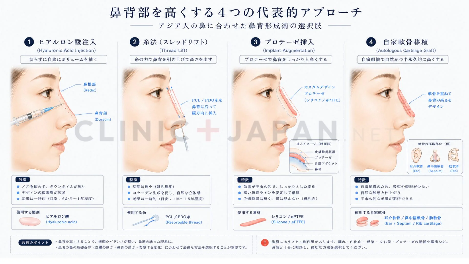隆鼻術の4方法 — プロテーゼ・自家軟骨・ヒアル・糸法の比較