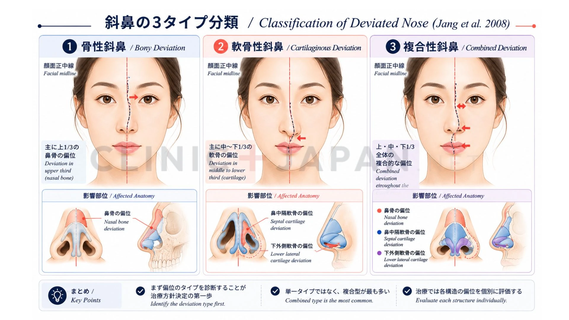 斜鼻の3タイプ — 軟骨性・骨性・複合性の解剖学的違い