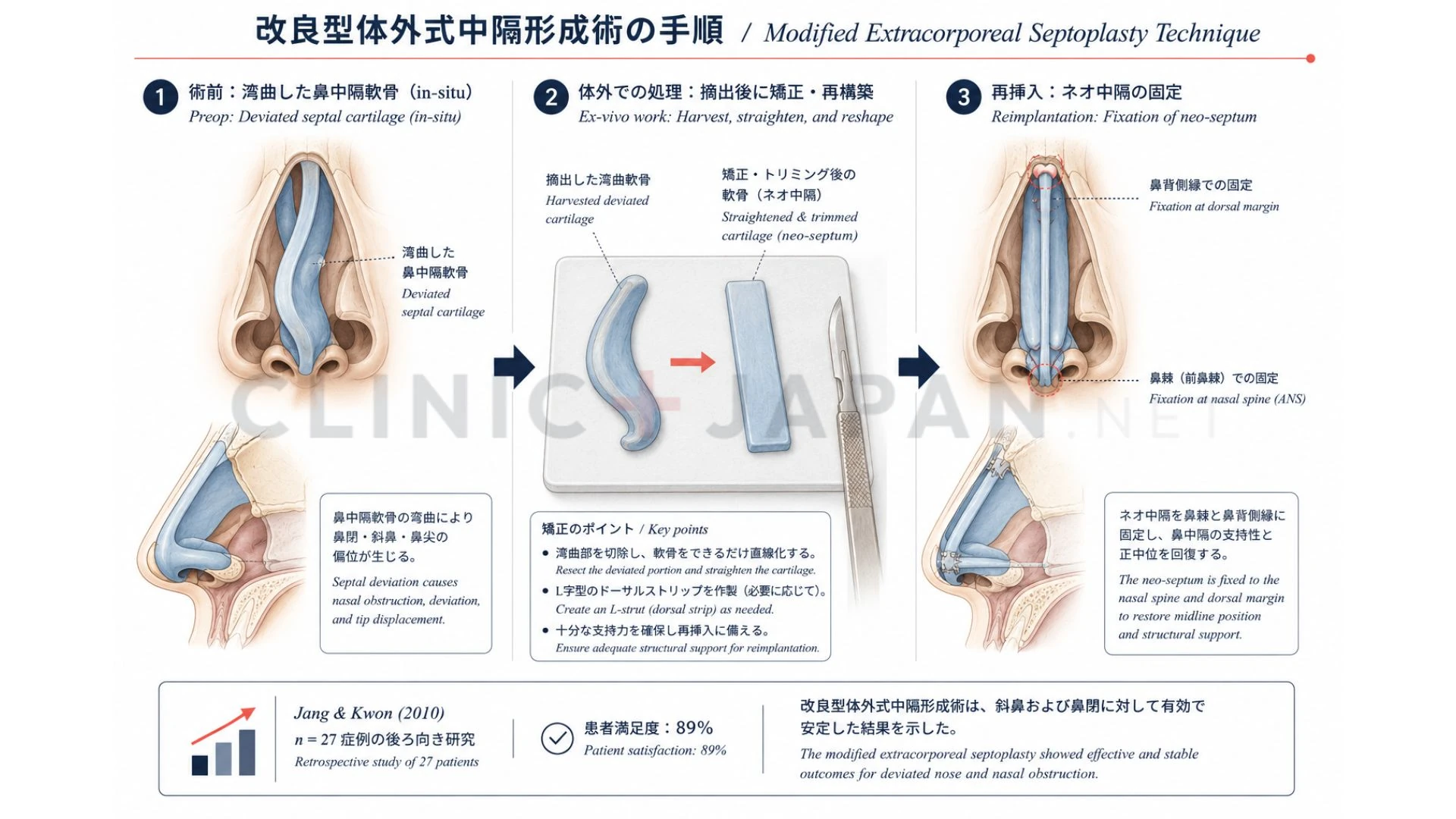 斜鼻矯正の術式 — osteotomy・septoplasty・spreader graft