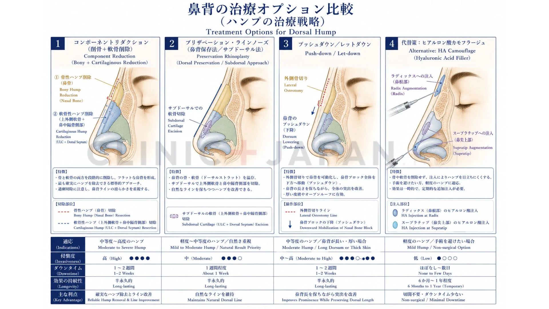 鷲鼻の治療法4種類 — component reduction・preservation・push-down・代替策の比較