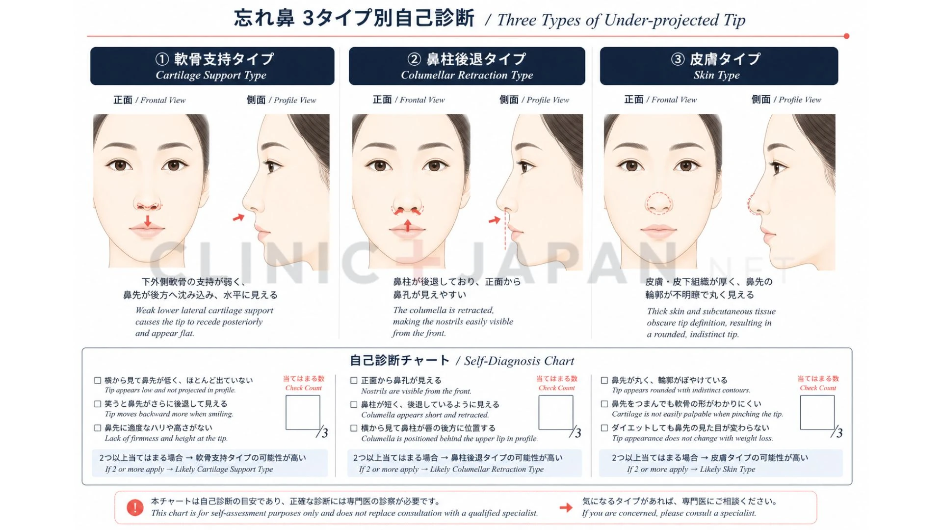 忘れ鼻の3タイプ — 軟骨支持・鼻柱後退・皮膚厚の解剖学的違い