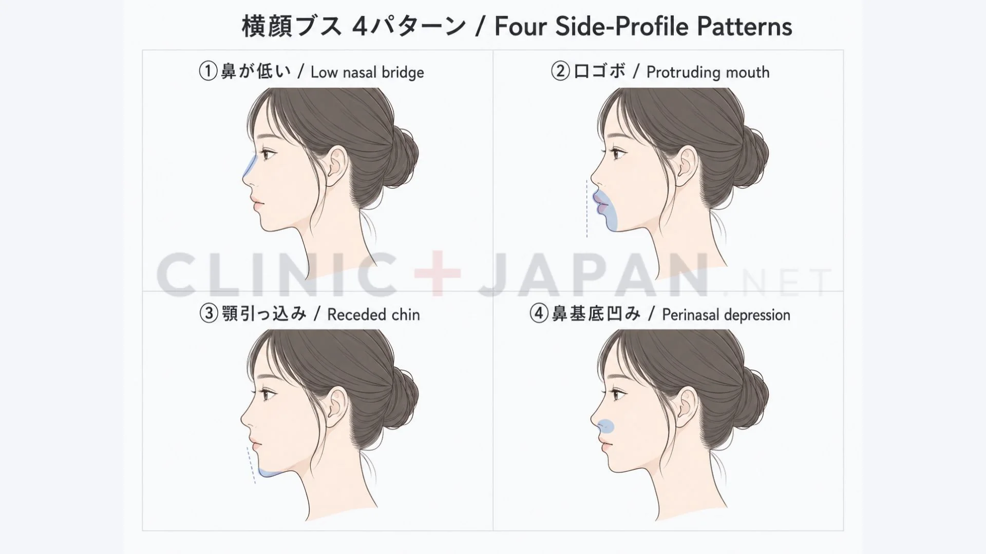 横顔の4パターン — 鼻低・口元突出・顎引っ込み・中顔面陥凹の判定図