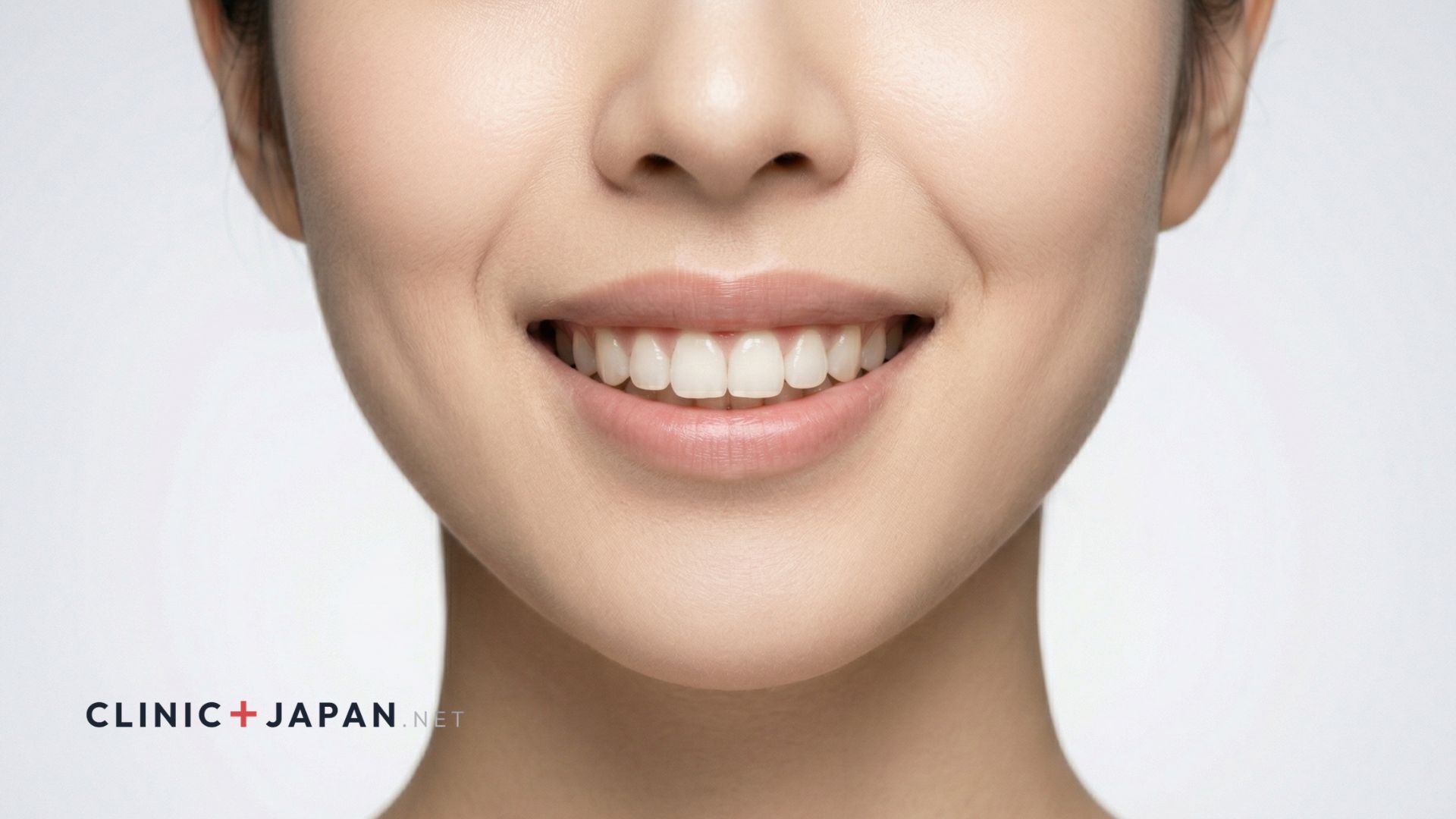 ガミースマイルボトックス — 上唇挙筋への注射で歯茎露出を抑制